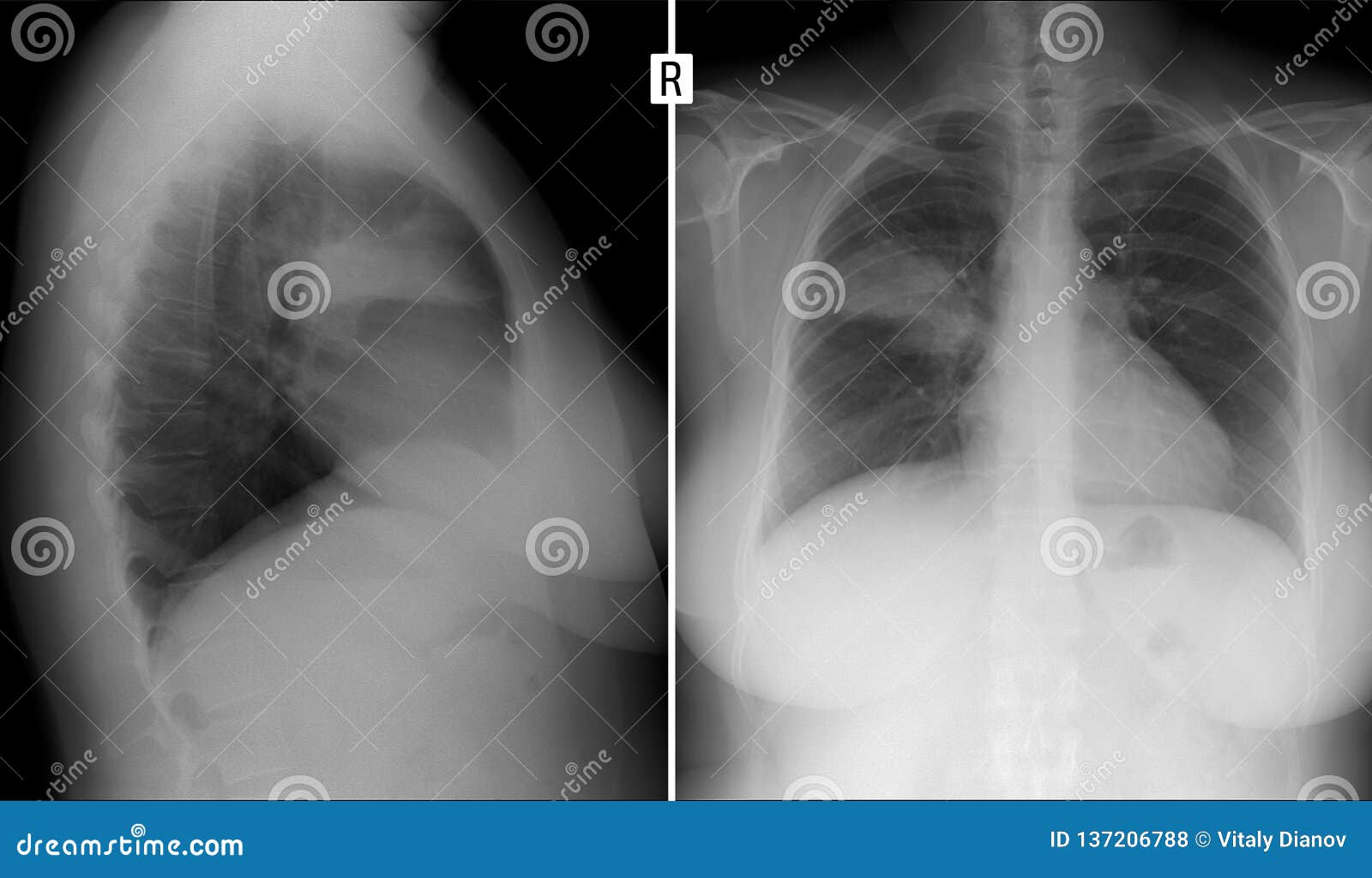 Air that cuts off circulation to a segment of the lung dead space Air that cuts off circulation to a segment of the lung dead space