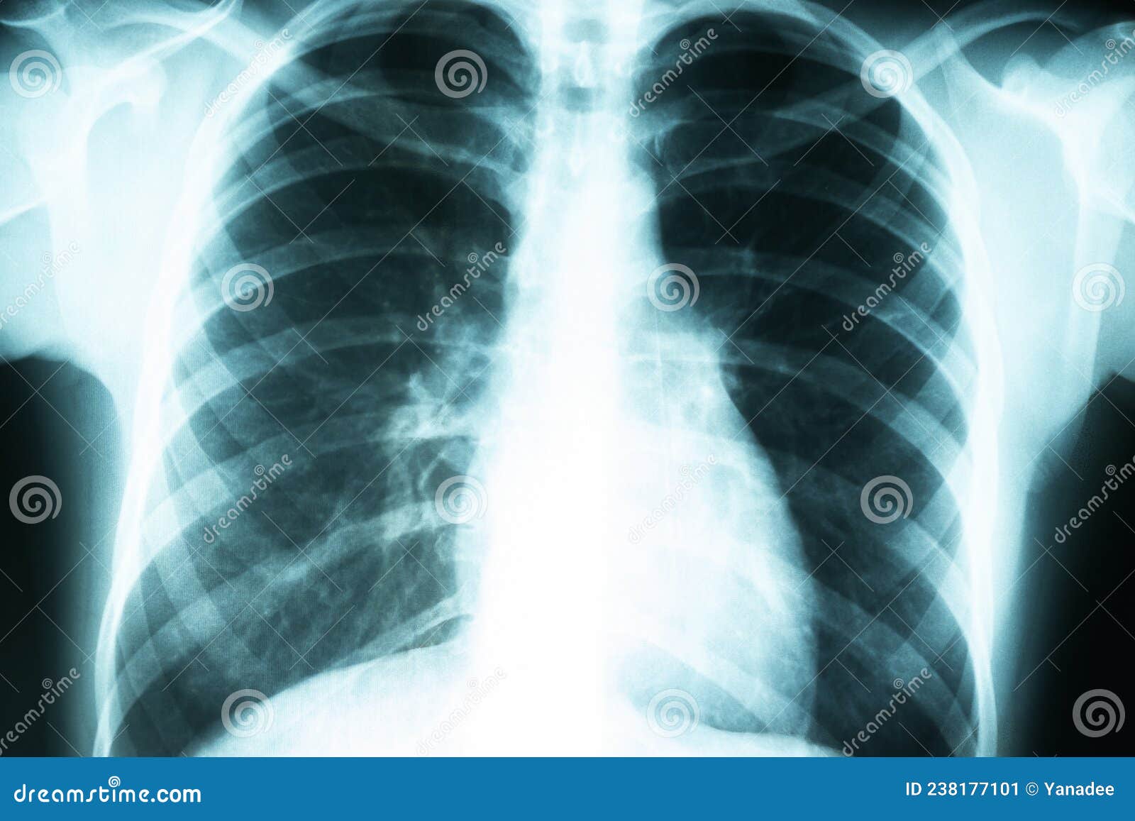 Xray of the Lungs, Radiological Examination of Chest Diseases Stock Image Image of asthma