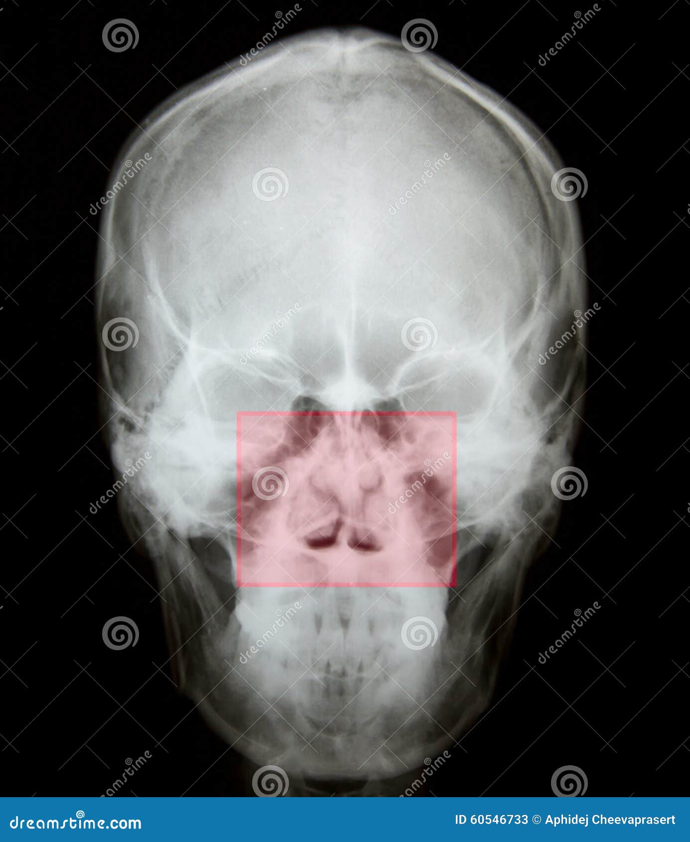 nasal bone x ray anatomy