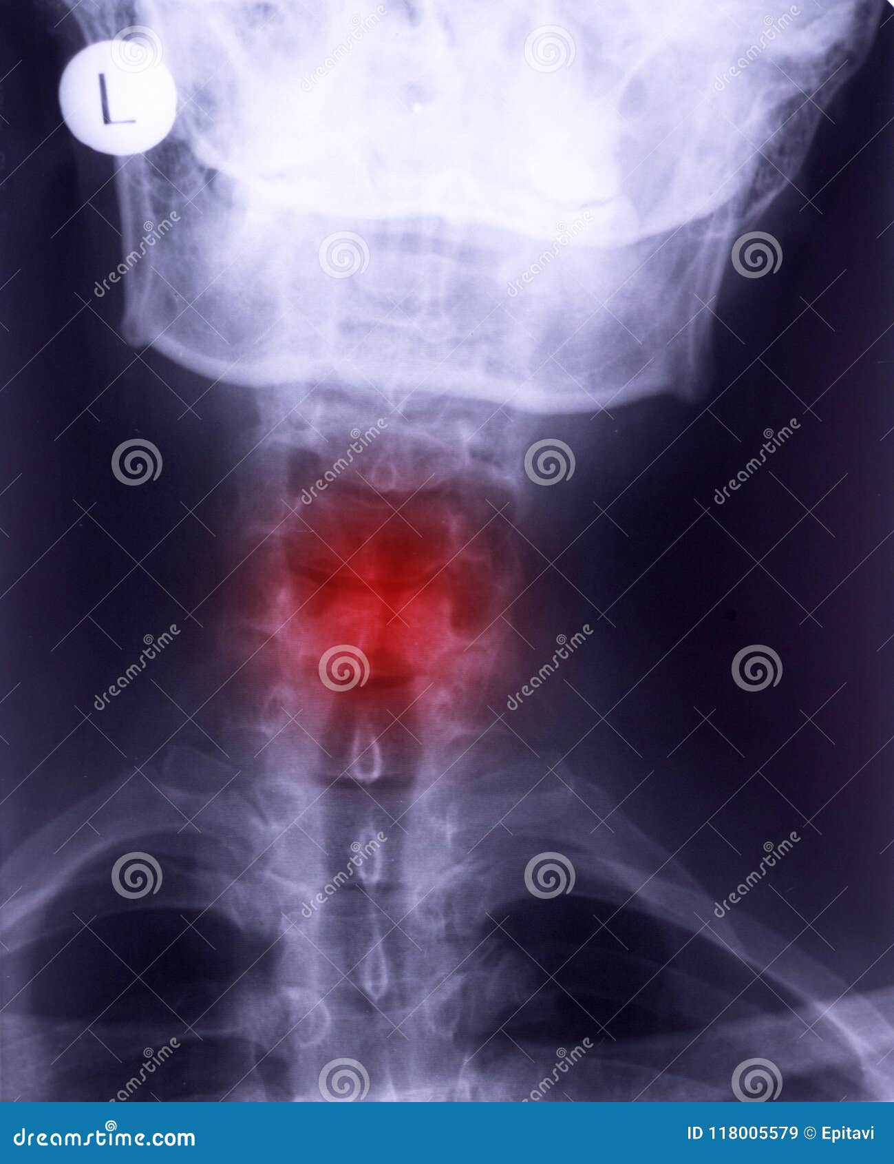 Xray of neck stock image. Image of defect, human, radiography 118005579