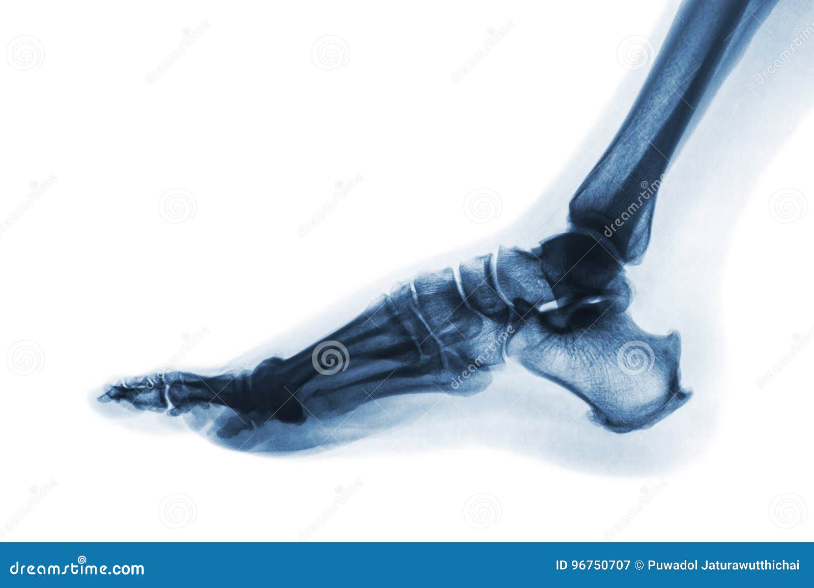 x-ray normal human foot . lateral view . invert color style