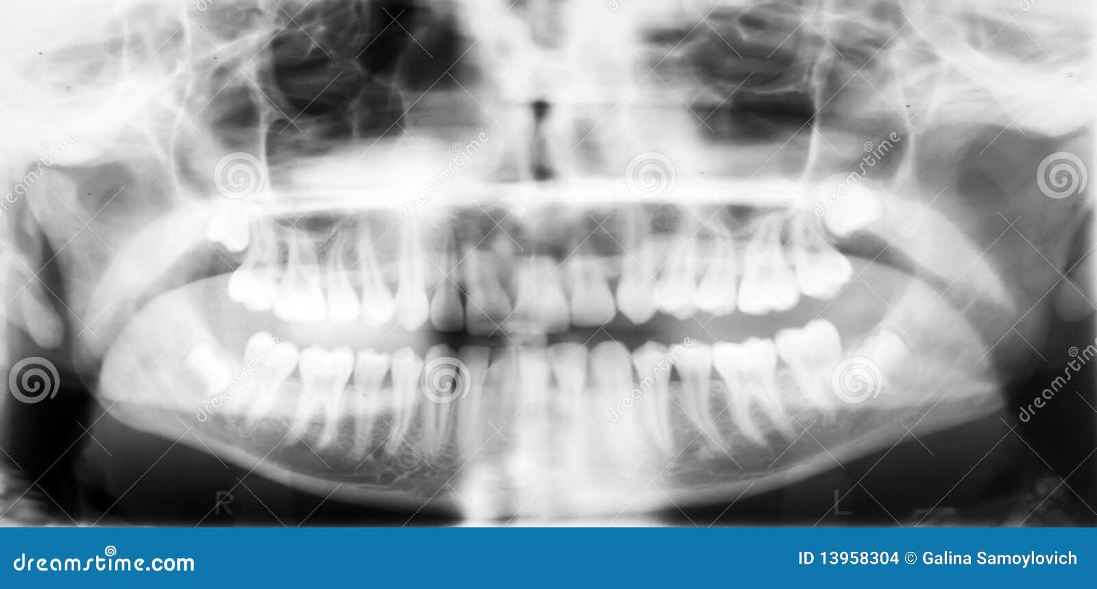 Xray of the oral cavity. stock photo. Image of radio 13958304