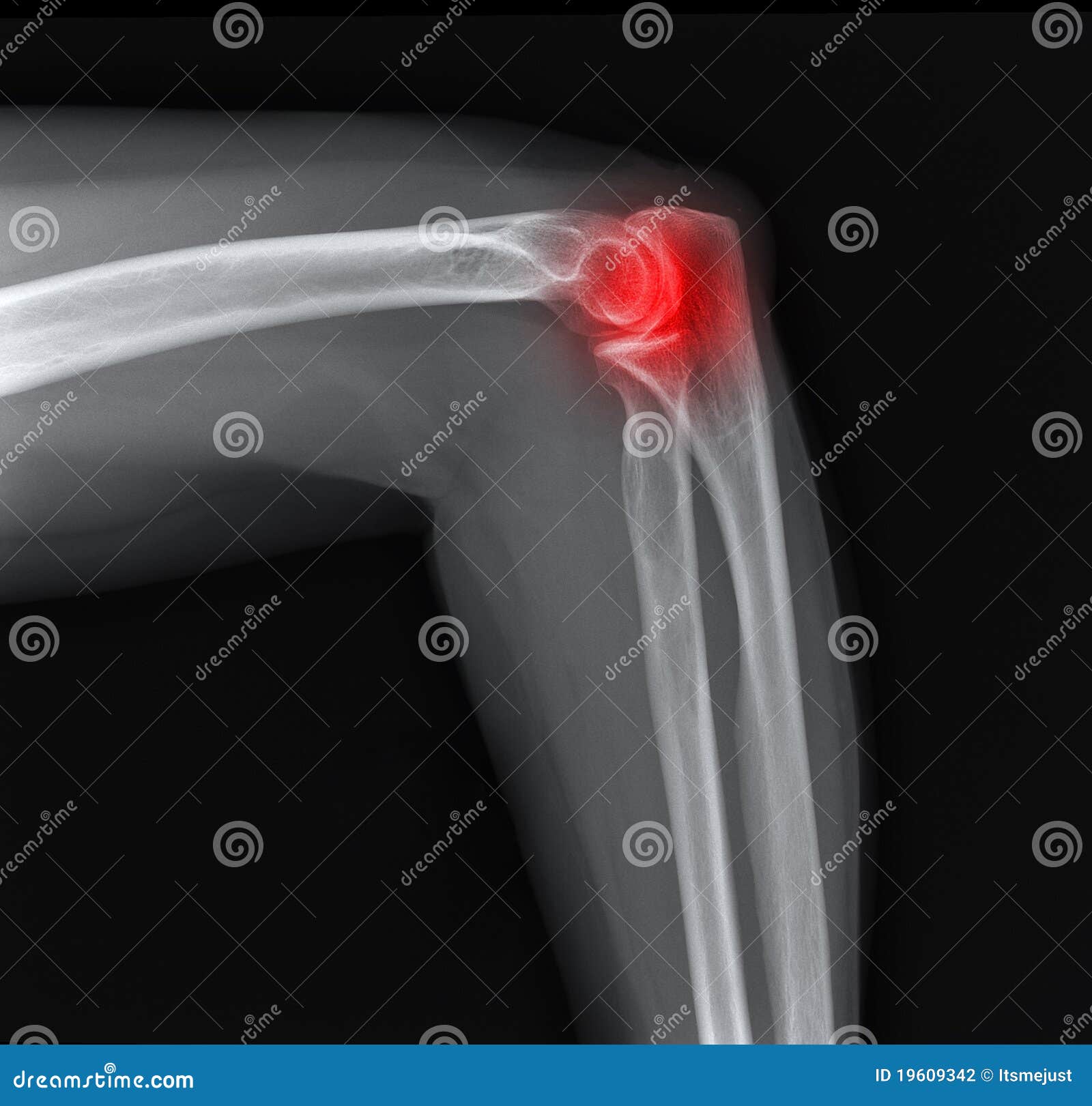 Xray of the Painful Elbow Joint. Stock Photo Image of player, tennis