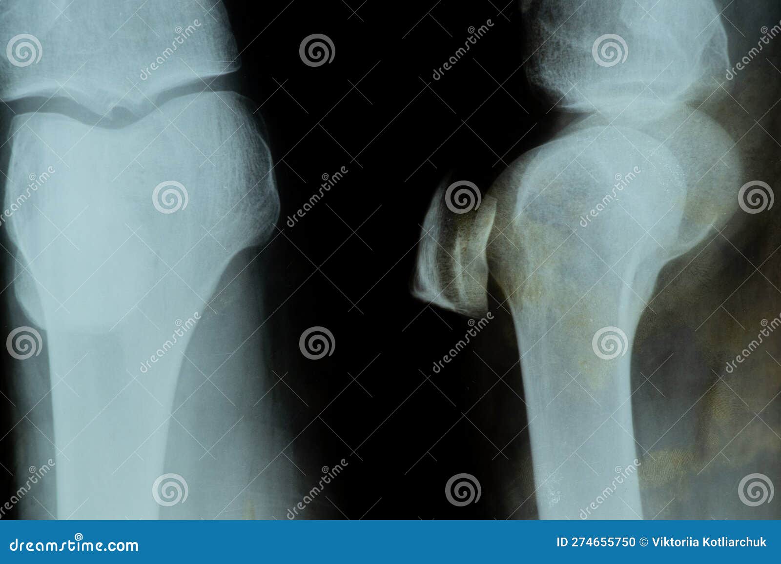 Xray of a Patient with a Torn Meniscus of the Knee Joint in a Man and