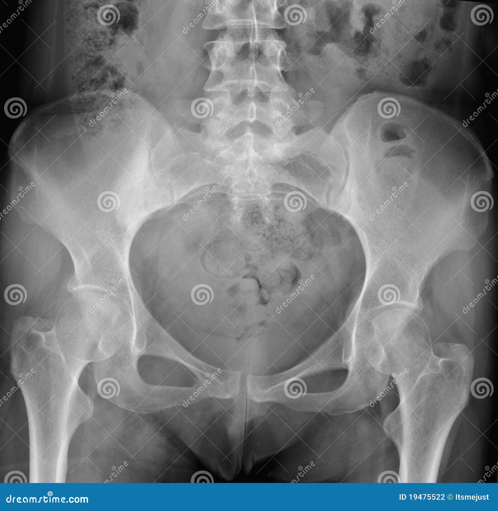 X-ray Of Pelvis. Stock Photography - Image: 19475522