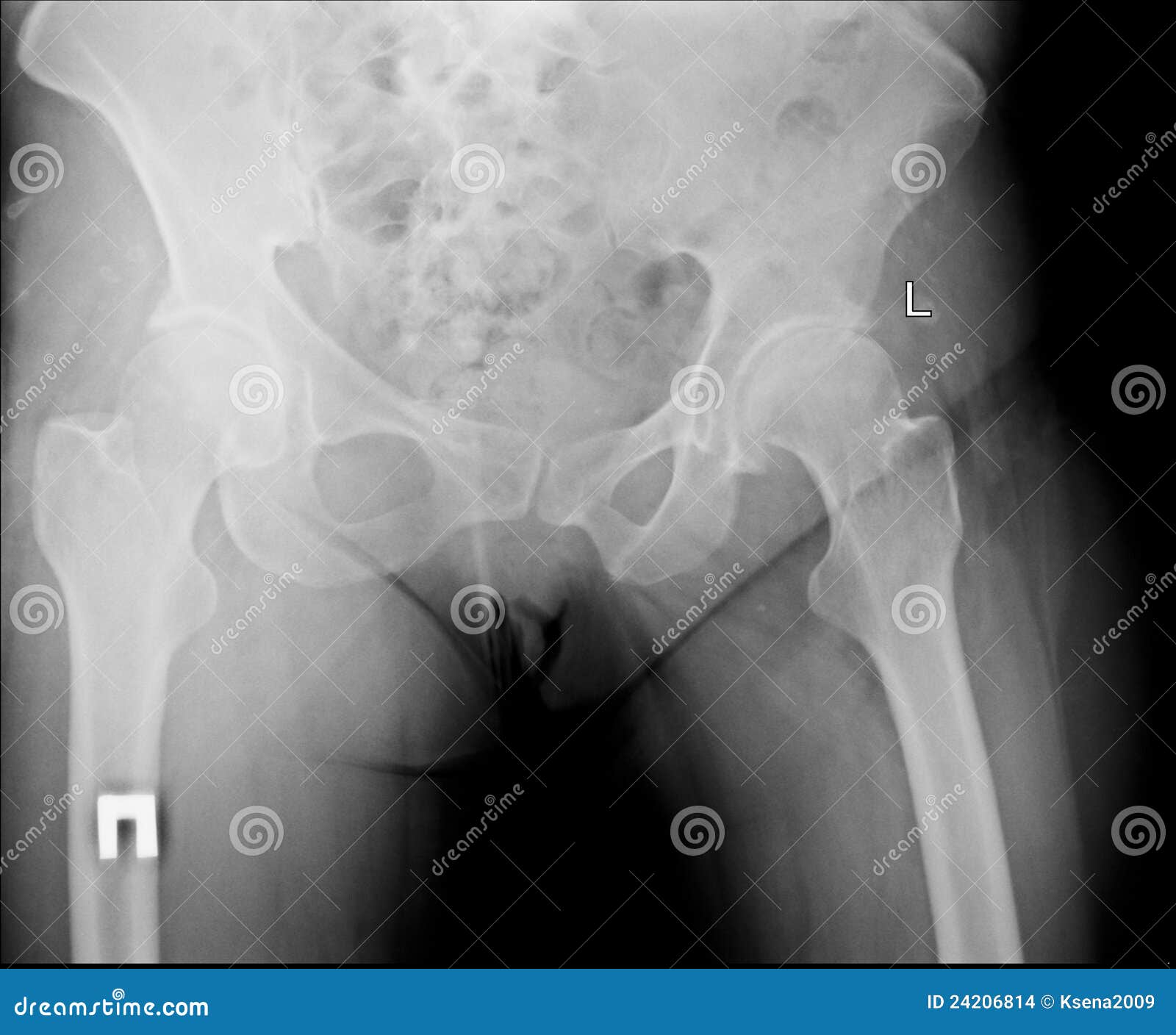 X-ray of the pelvis stock photo. Image of healthcare - 24206814