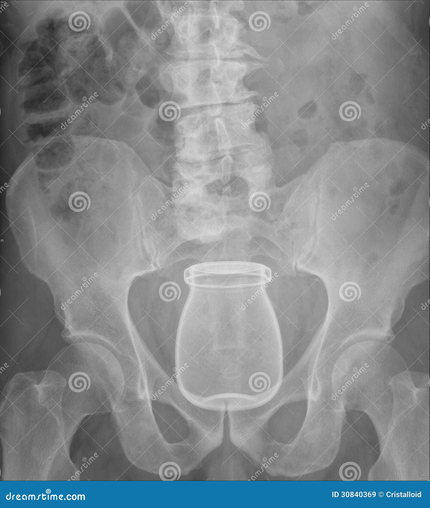 X Ray Of Pelvis With Glass Inserted In Rectum Royalty Free