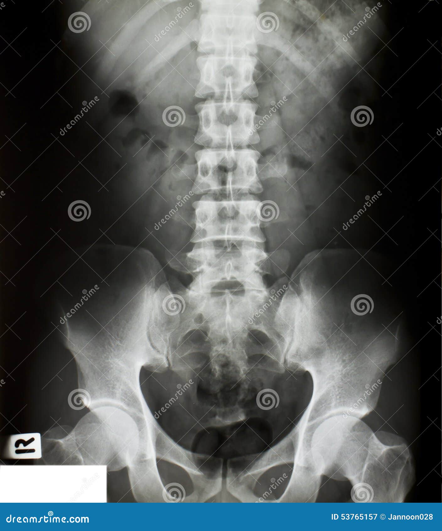 Xray of the pelvis stock image. Image of anatomy, closeup 53765157