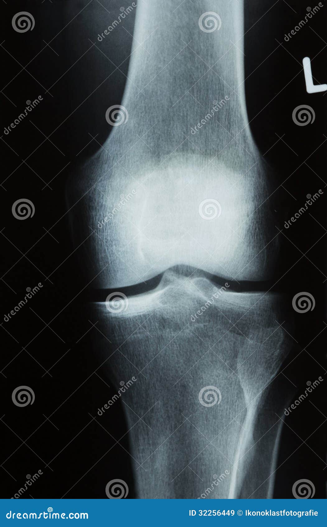 X-ray Photo Of A Human Knee Royalty Free Stock Images - Image: 32256449