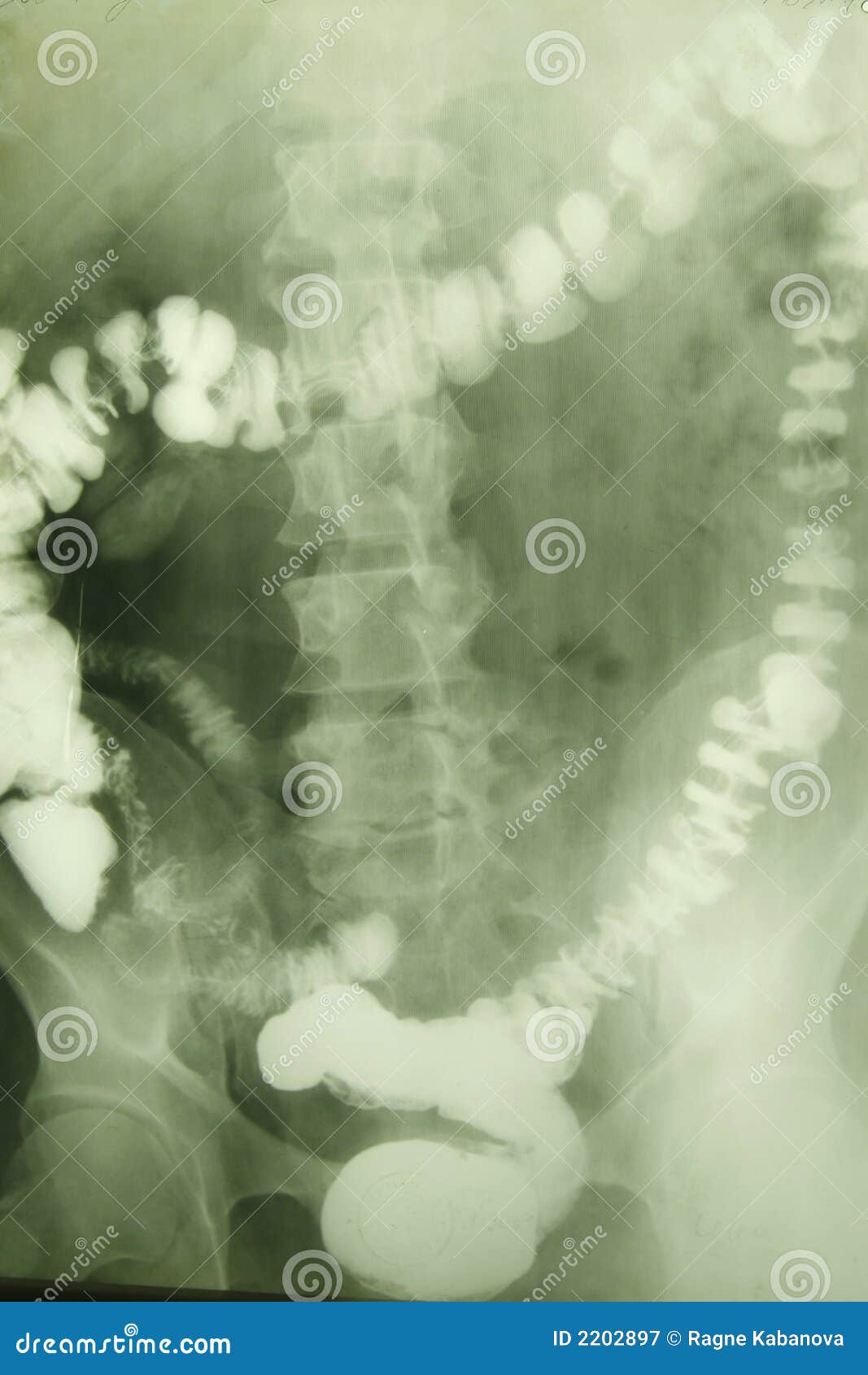 x-ray photo of a vertebra