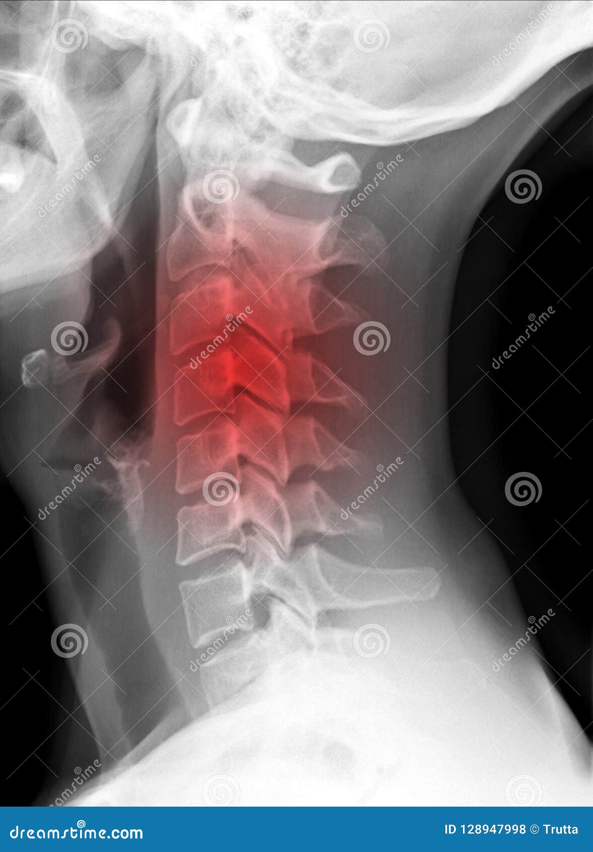 x-ray picture - cervical spine