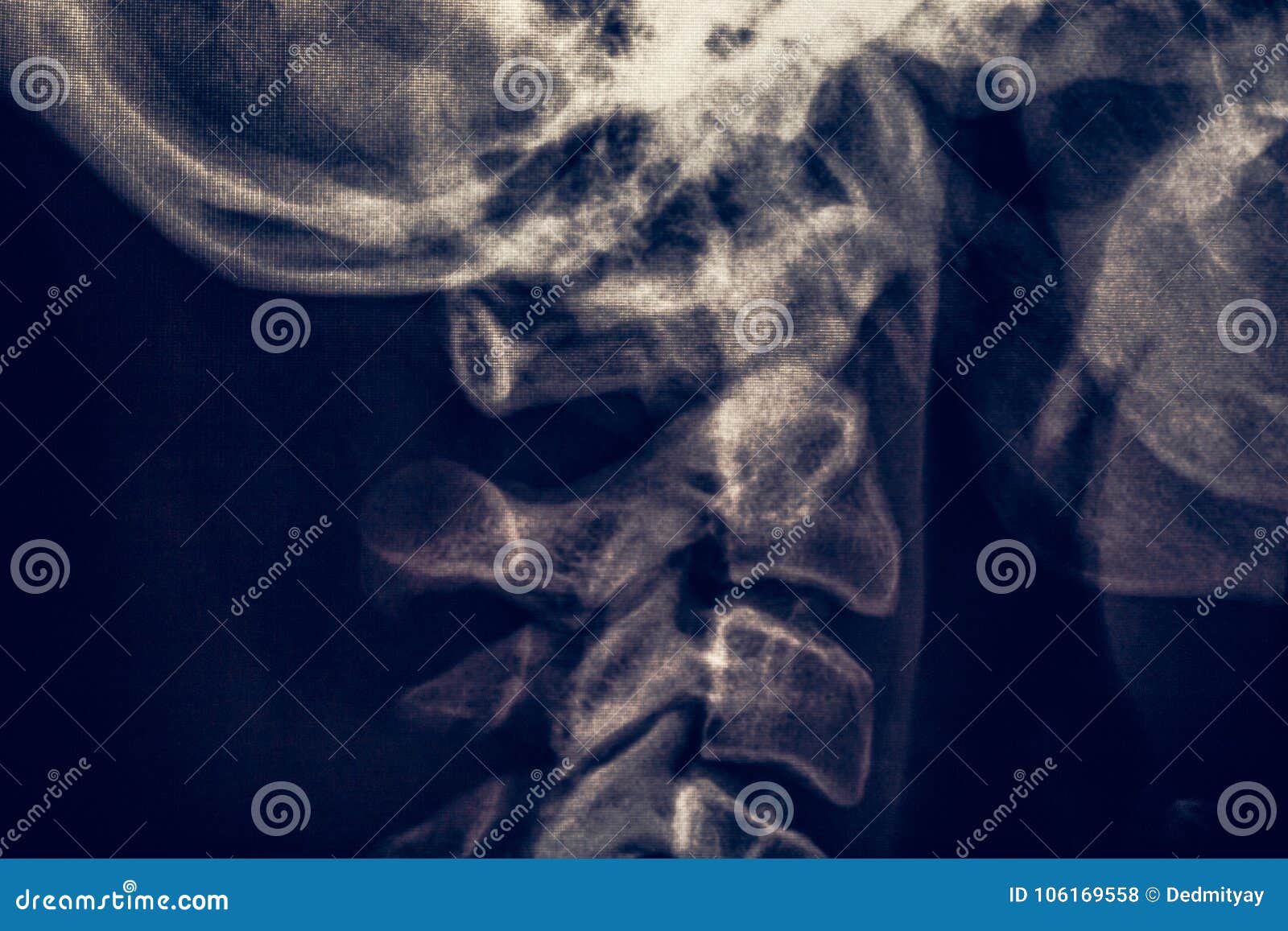x-ray radiography or roentgen of human neck, medical radiology concept