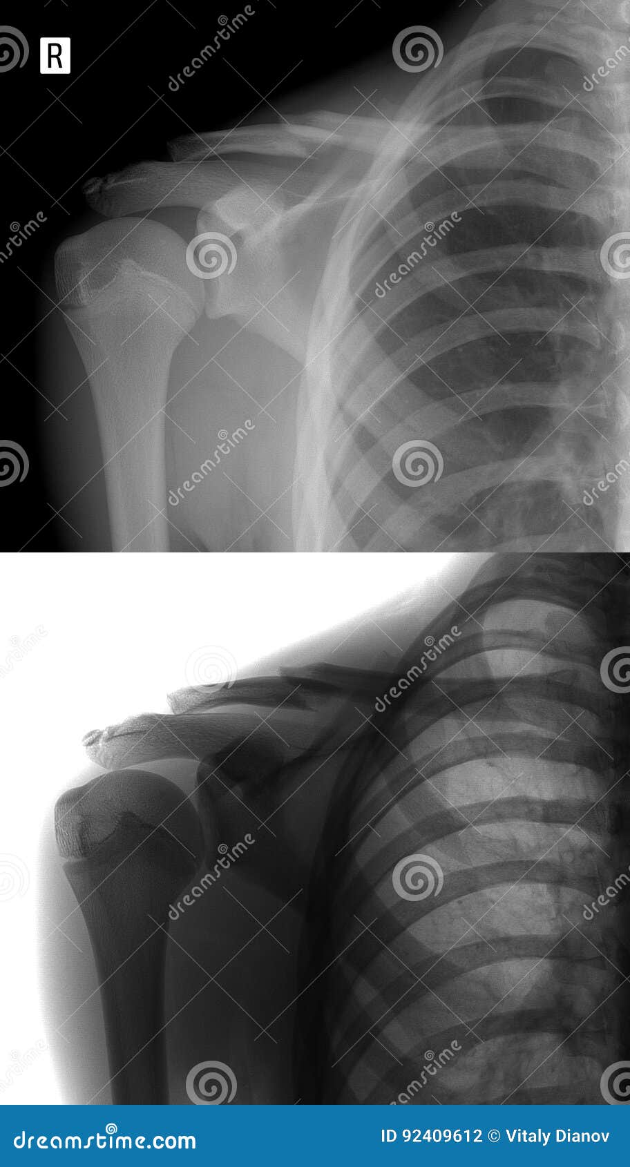 X Ray Of The Right Collarbone Fracture Of Clavicle Stock Photo