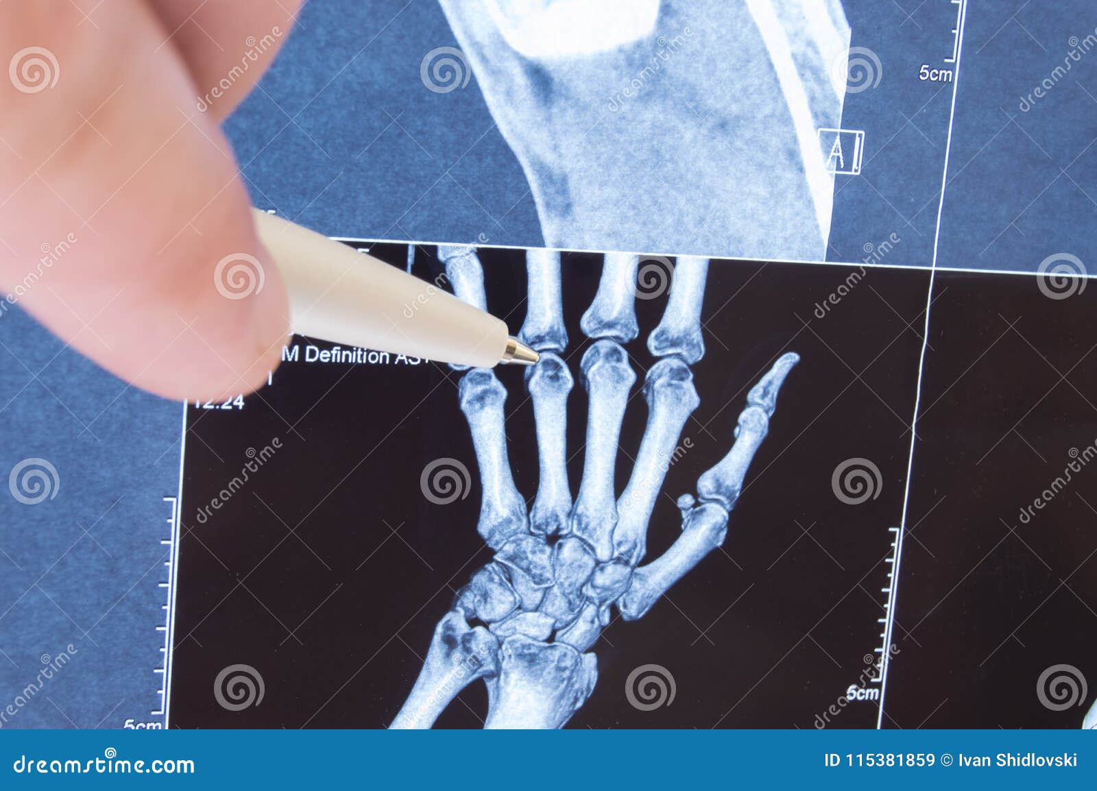 x-ray scan of hand, bones and finger joints. doctor pointed on finger small joints, where pathology is detected, such as arthritis
