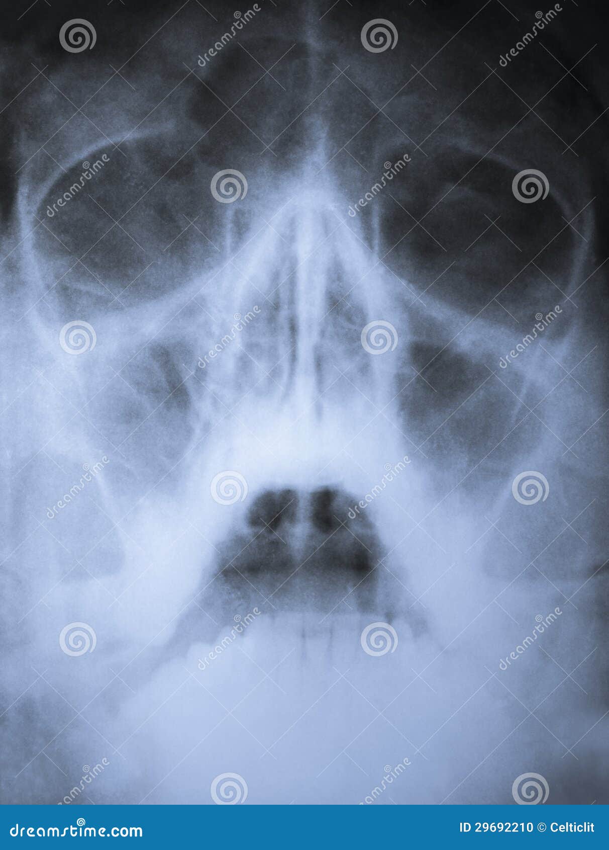 X Ray Broken Nose Stock Images Download 48 Royalty Free Photos