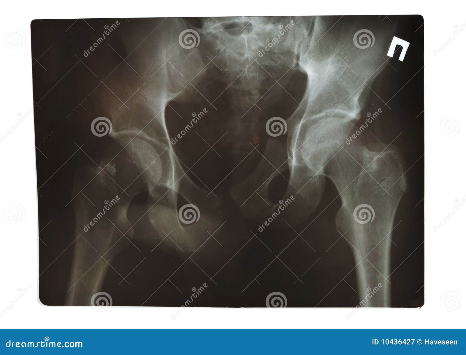 XRay shot stock image. Image of groin, medicine, spine 10436427