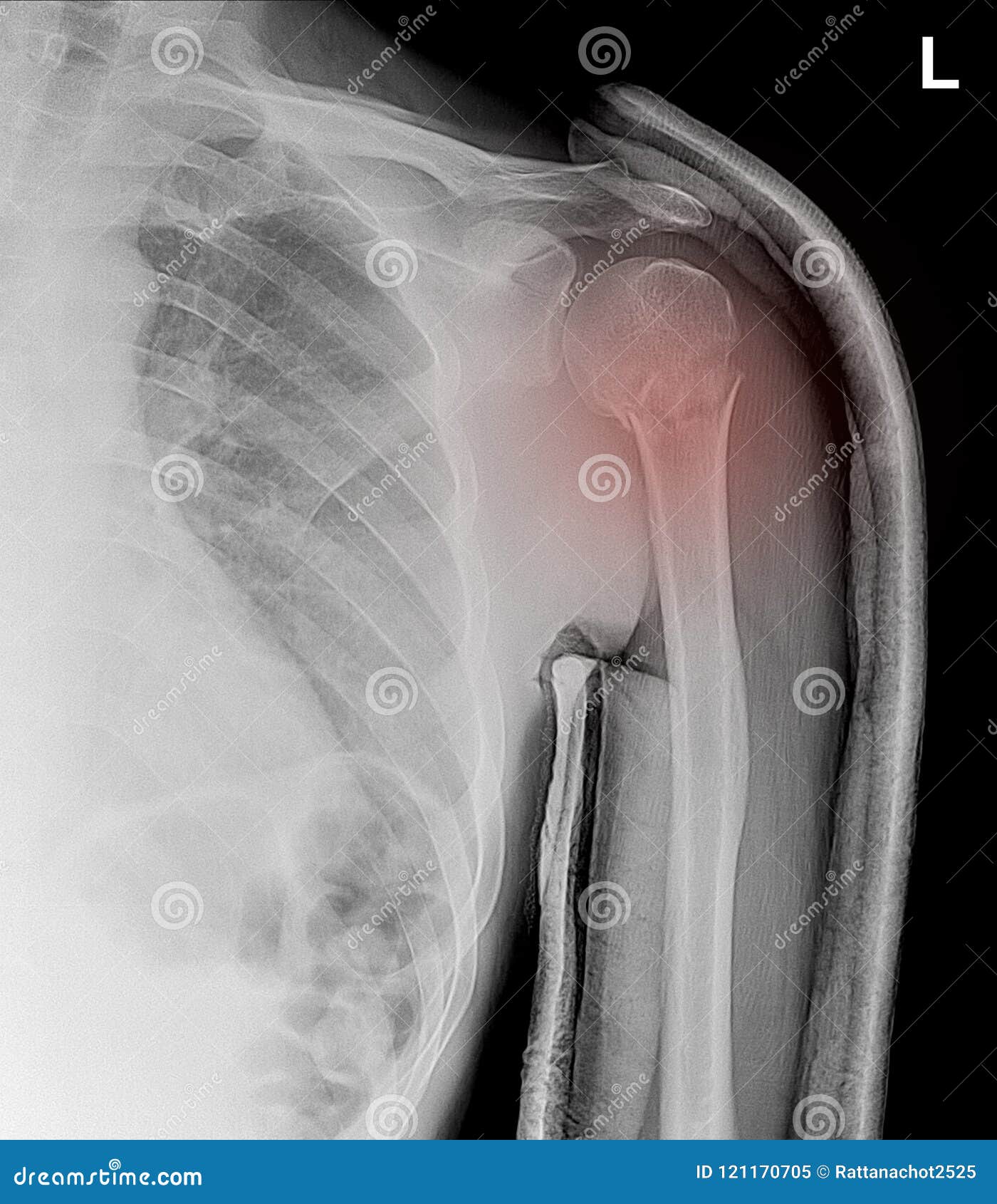 x-ray shoulder showed closed fracture left humerus