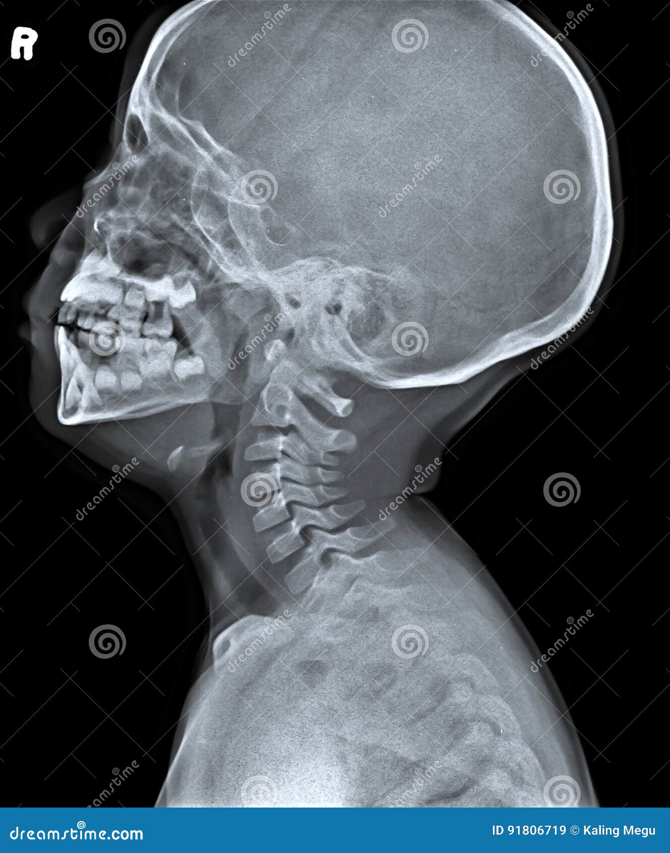 X Ray of Side View of Human Child Skull. Stock Image Image of head