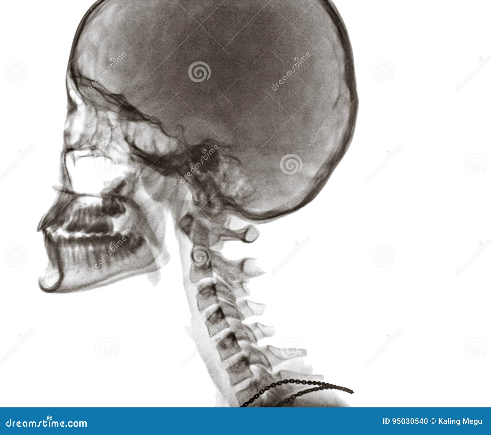 X Ray of Side View of Human Child Skull. Stock Photo Image of anatomy
