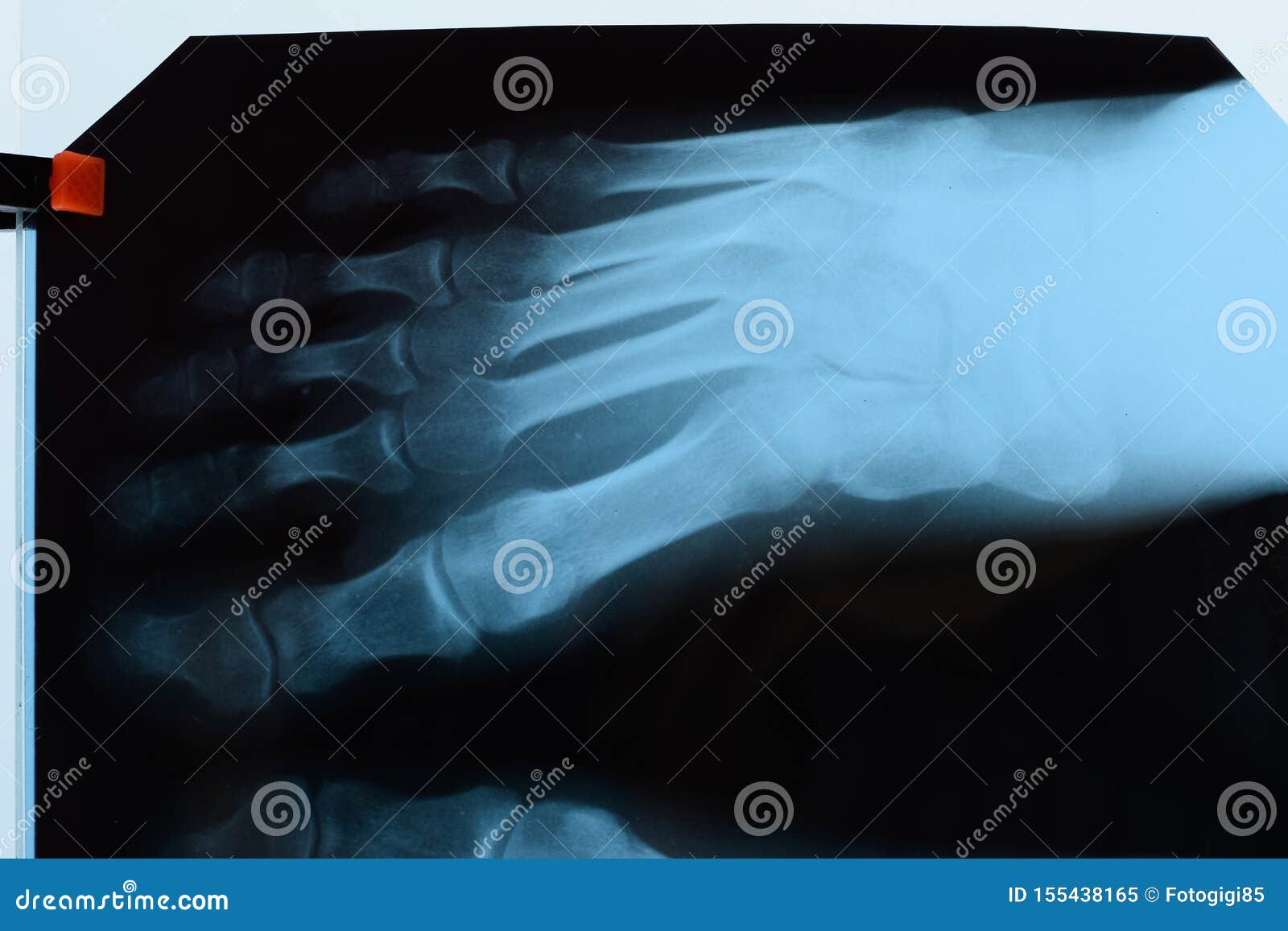 Xray Of Toes. Foot On Xray. Bone Research Stock Image Image of