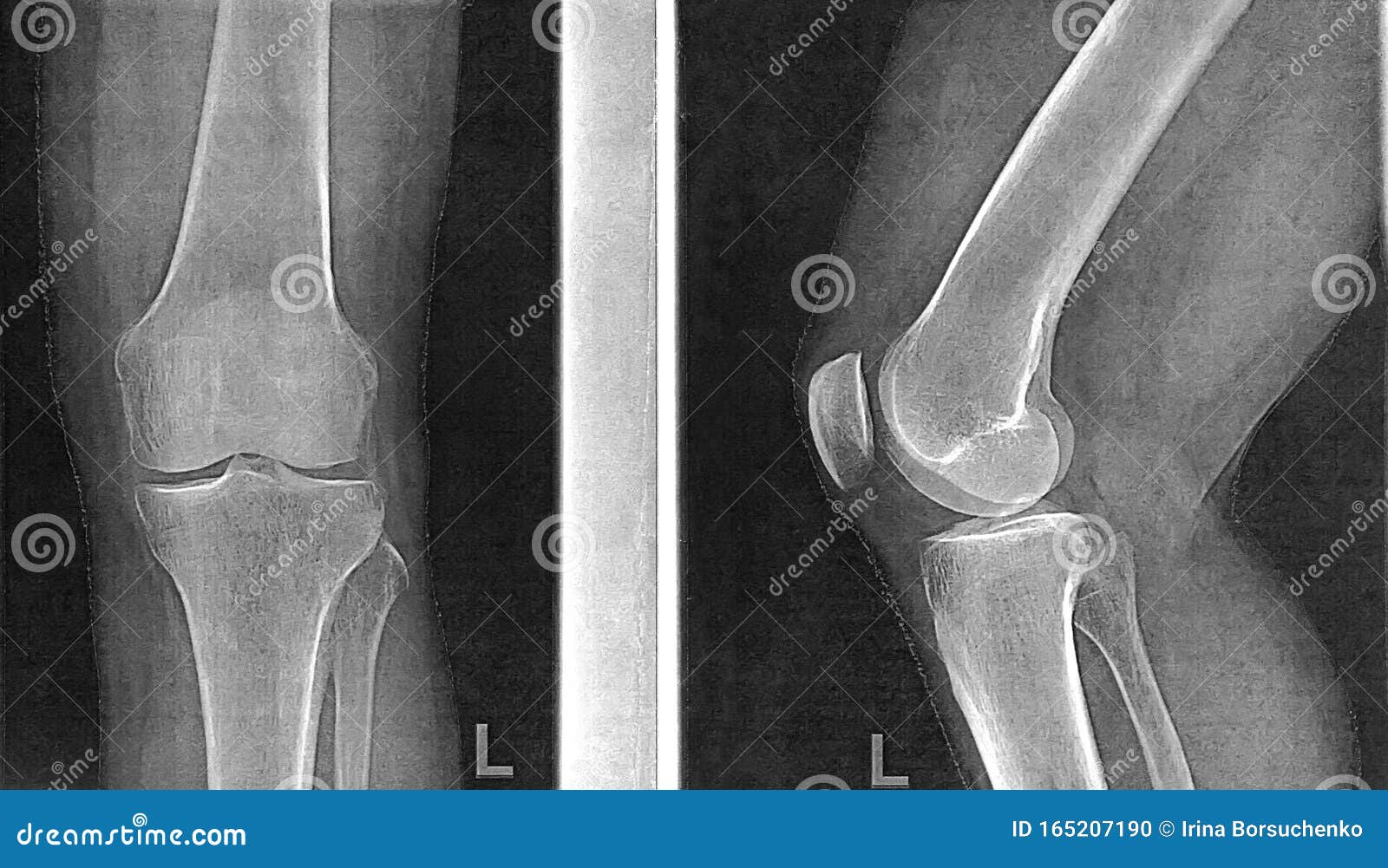 Рентген колена. Коленный сустав в 2 проекциях рентген. Рентген здорового коленного сустава в двух проекциях. Рентгенография коленного сустава (2 проекции). Рентген коленного сустава боковая проекция гонартроз.