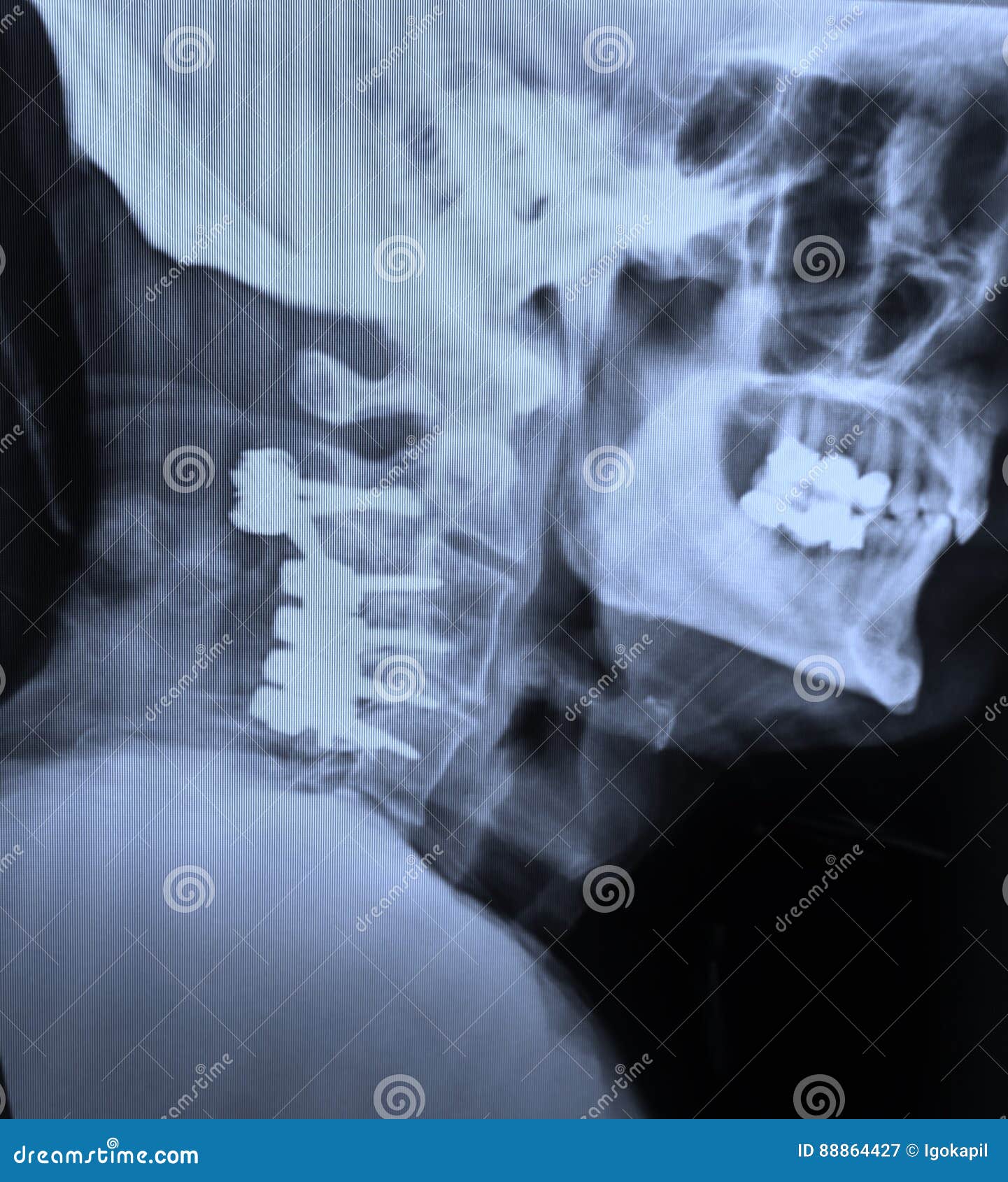 xray cervical spine fixation hardware after car accident