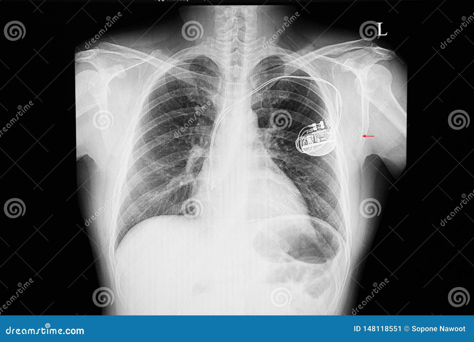 Xray Film of a Patient with Cardiac Pace Macker Stock Image - Image of ...