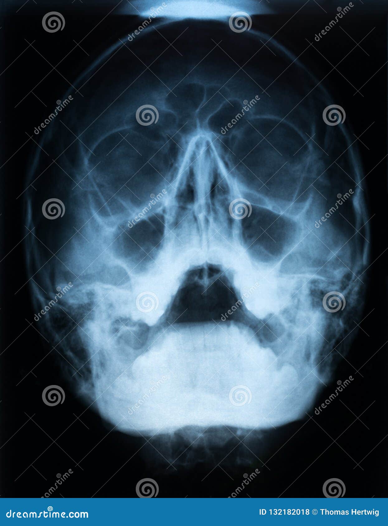 Sinusitis At Frontal Ethmoid Maxillary Sinus Film X Ray Of Skull And Blank Area At Right