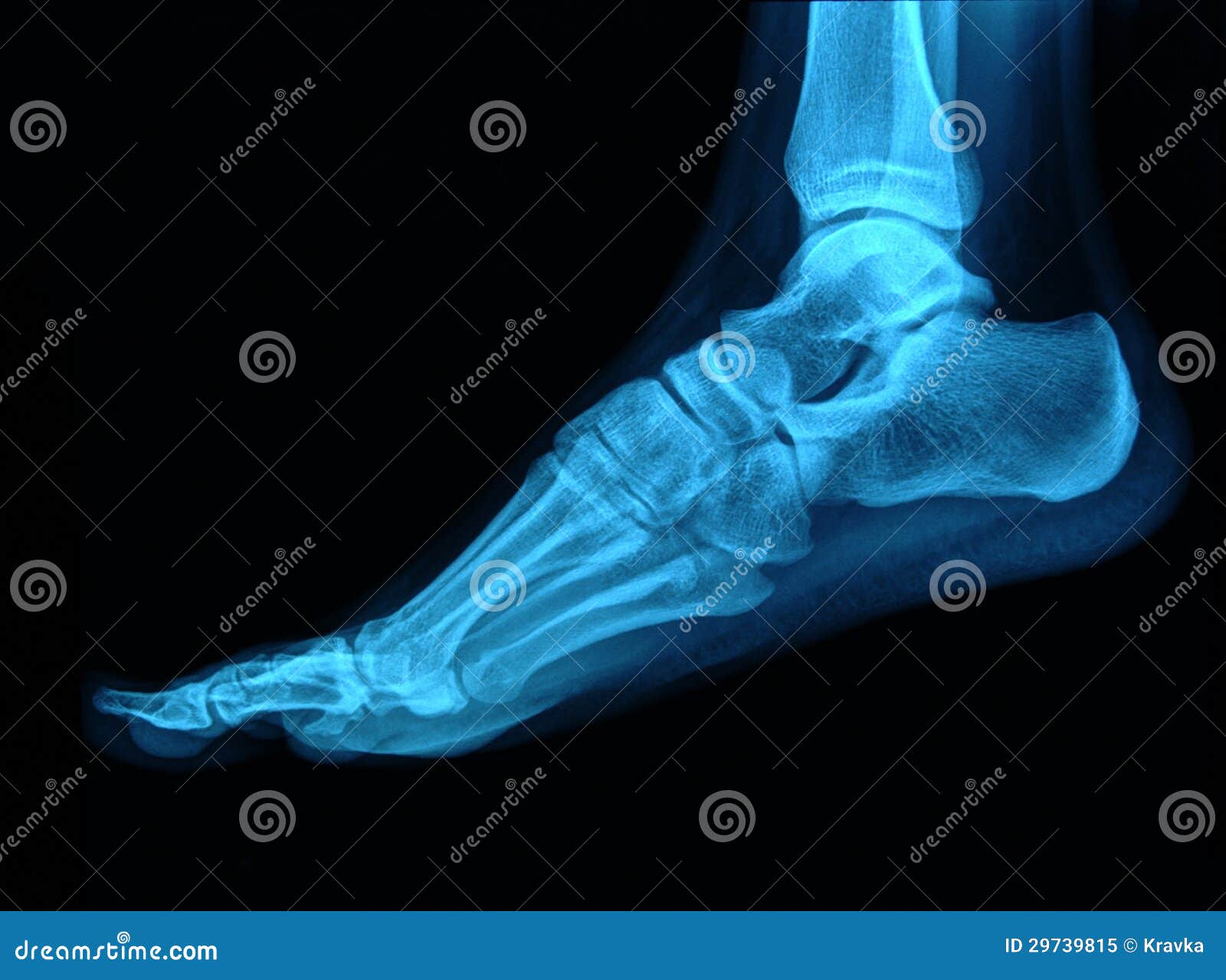Foot xray stock image. Image of heal, radiography, healthcare 29739815
