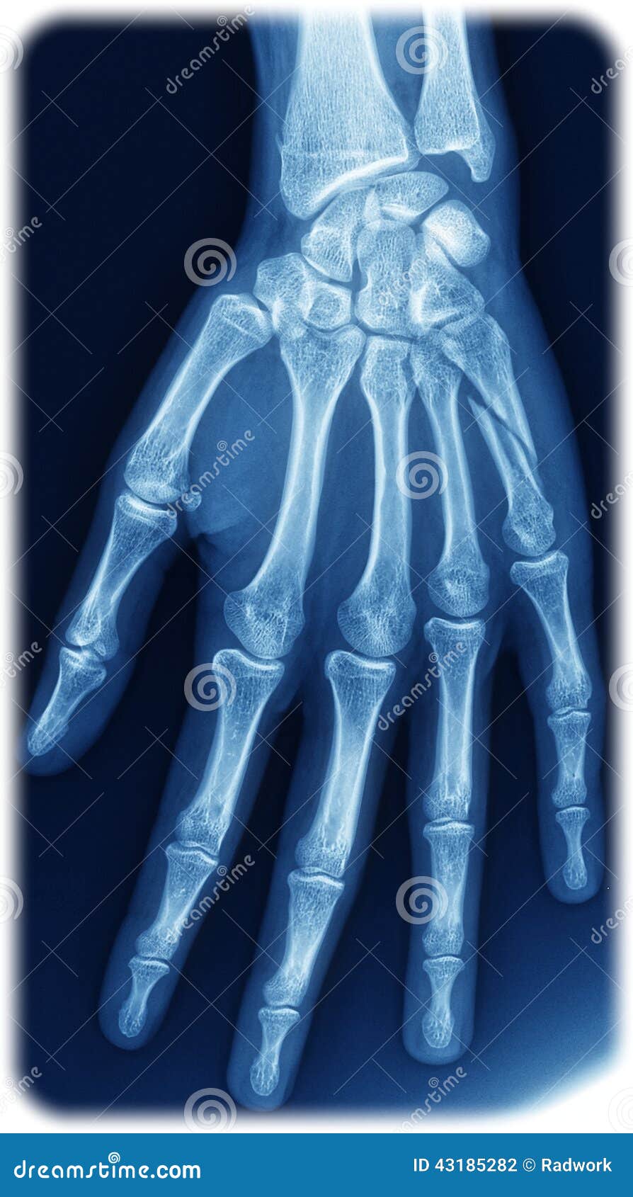 xray hand