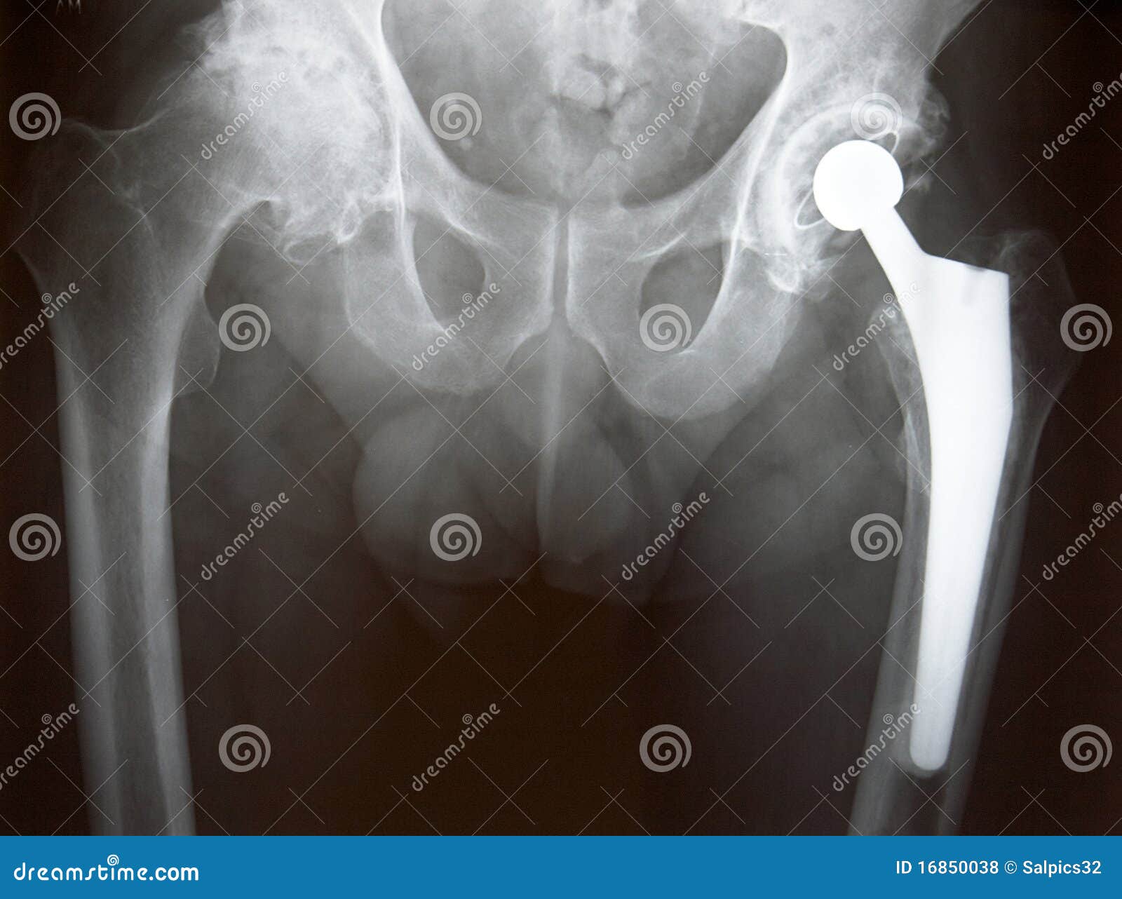 Xray of Hip Replacement stock photo. Image of replacement 16850038