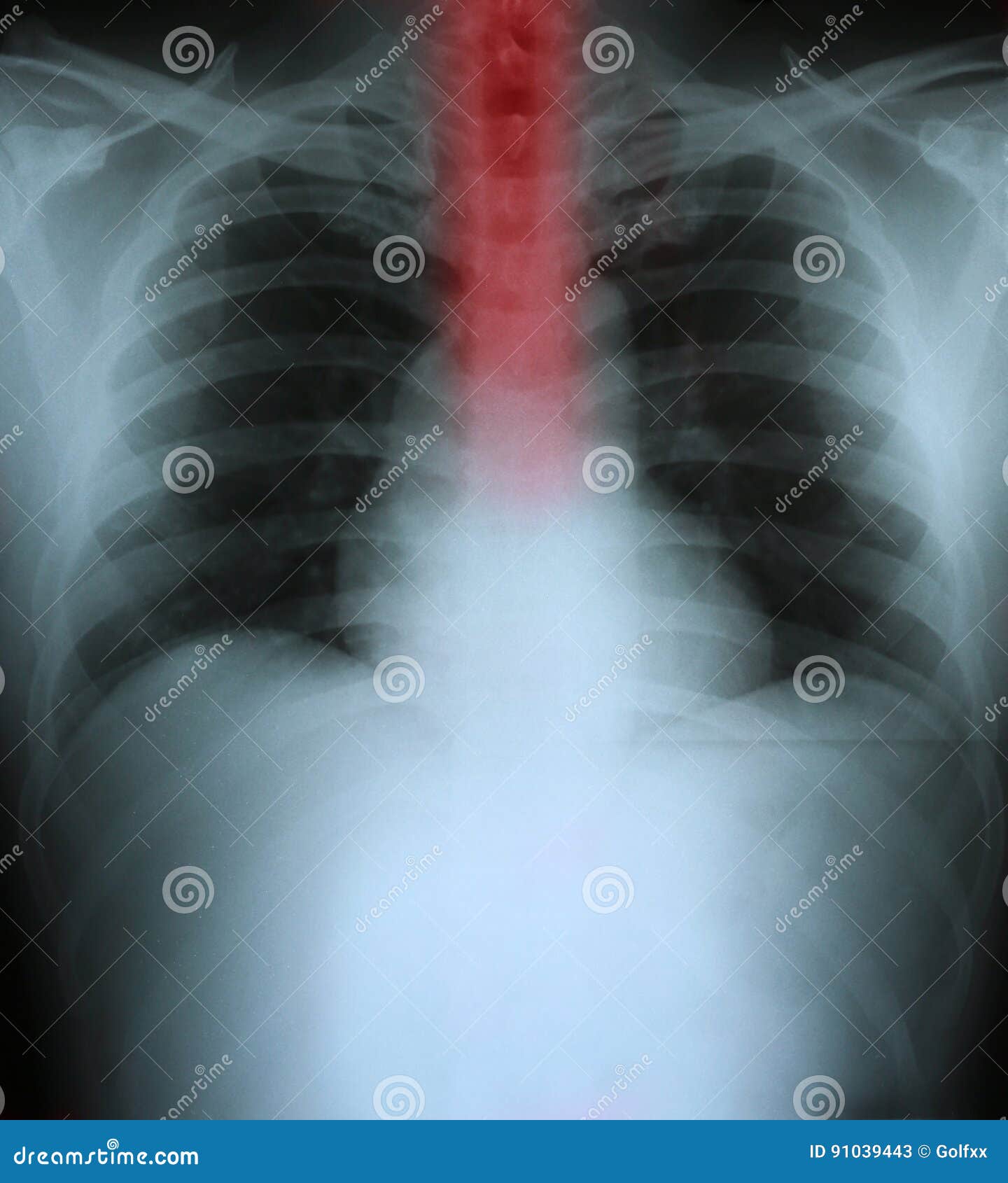 Xray of a Human Thorax with Esophagus Highlighted Stock Image Image