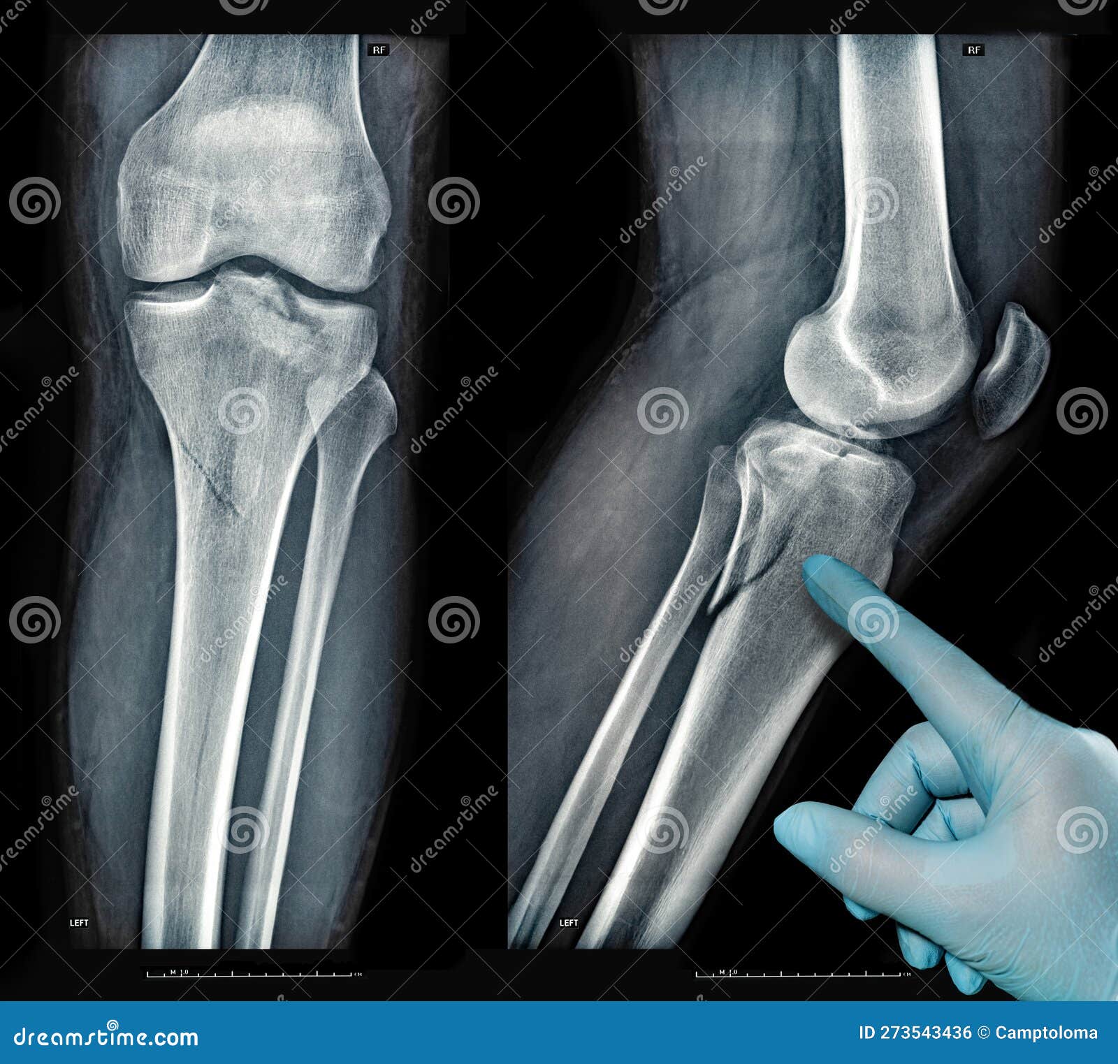 Xray of online broken knee