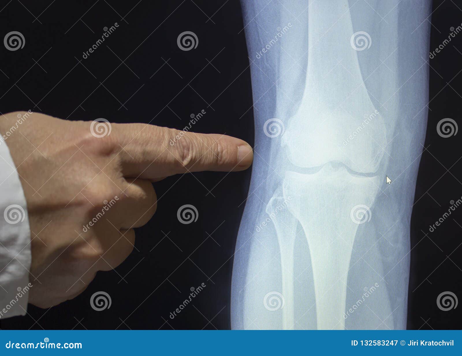 Трещина в организме. Рентген колена. Рентген коленного сустава. Снимки коленного сустава.