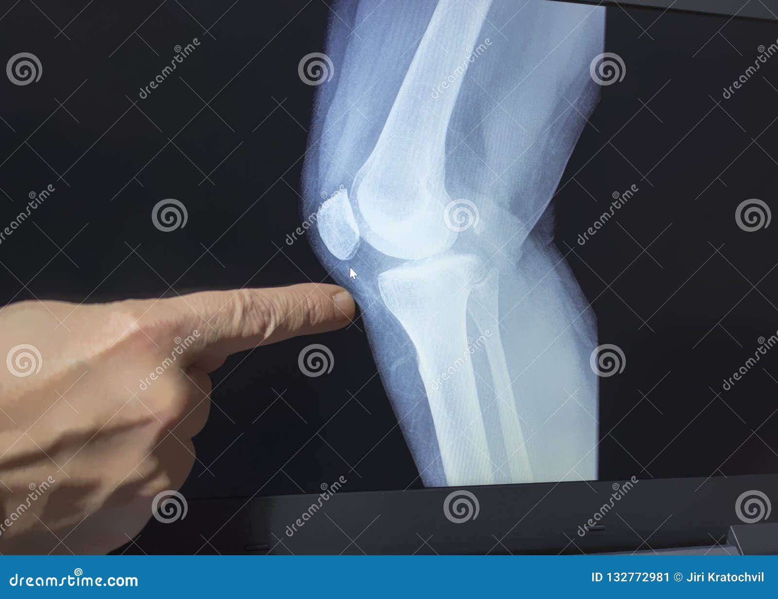 Трещина в суставе. Рентген колена. Рентгеновский снимок колена. Рентгенография коленной чашечки.