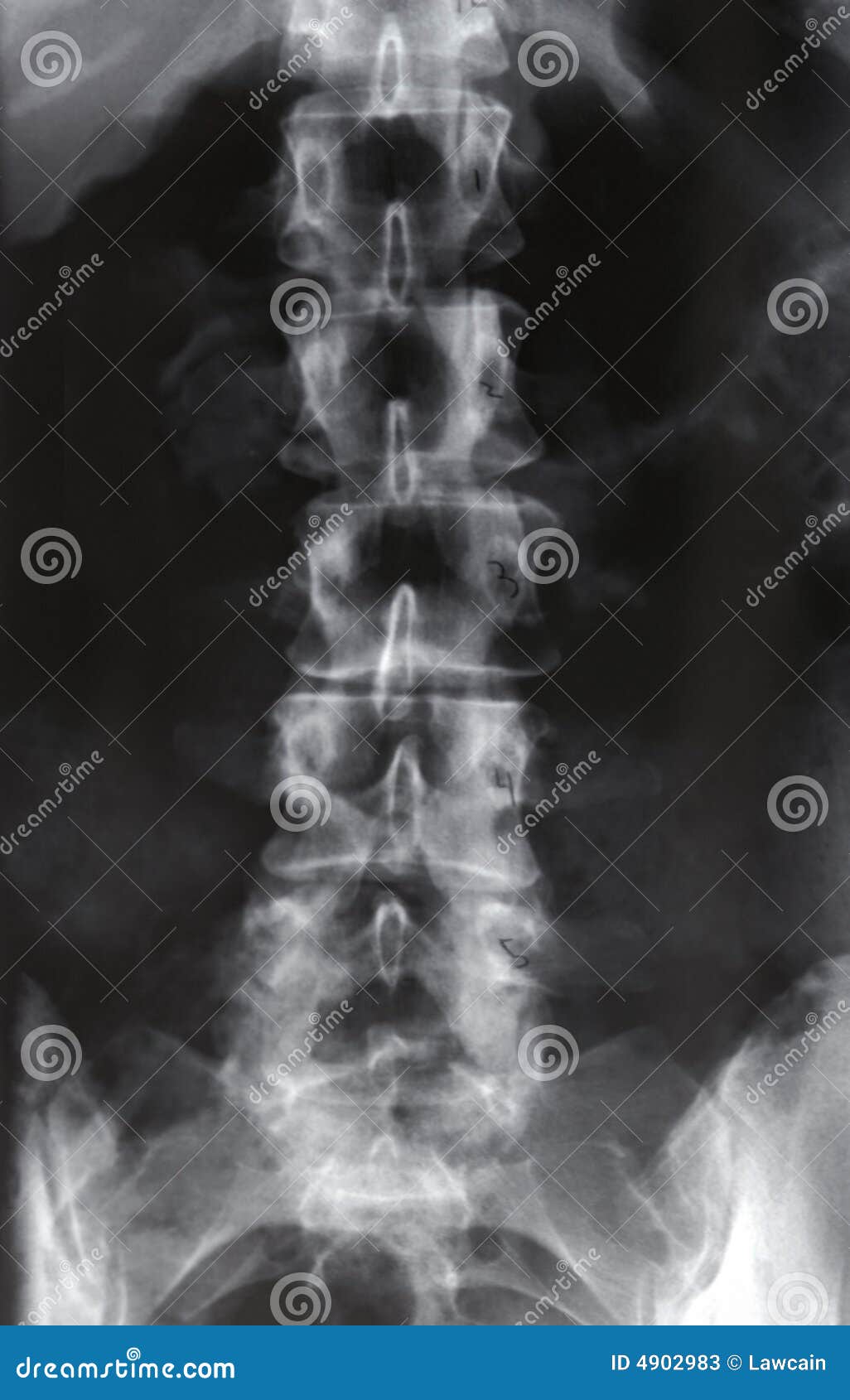 Xray, Lumbar Spine stock image. Image of medical, arthritis - 4902983