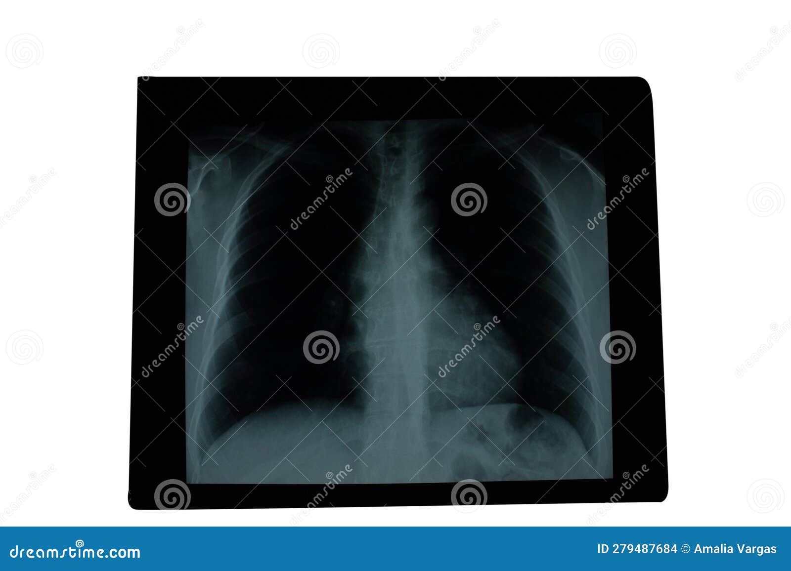 xray lungs radiological image of patient lung parenchyma homogeneous radiographic pattern and aortic button prominence