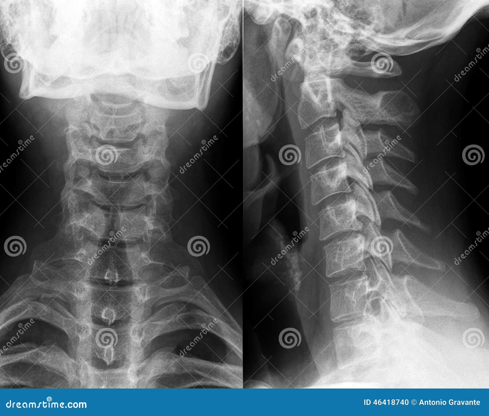 xray of neck and cervical spine