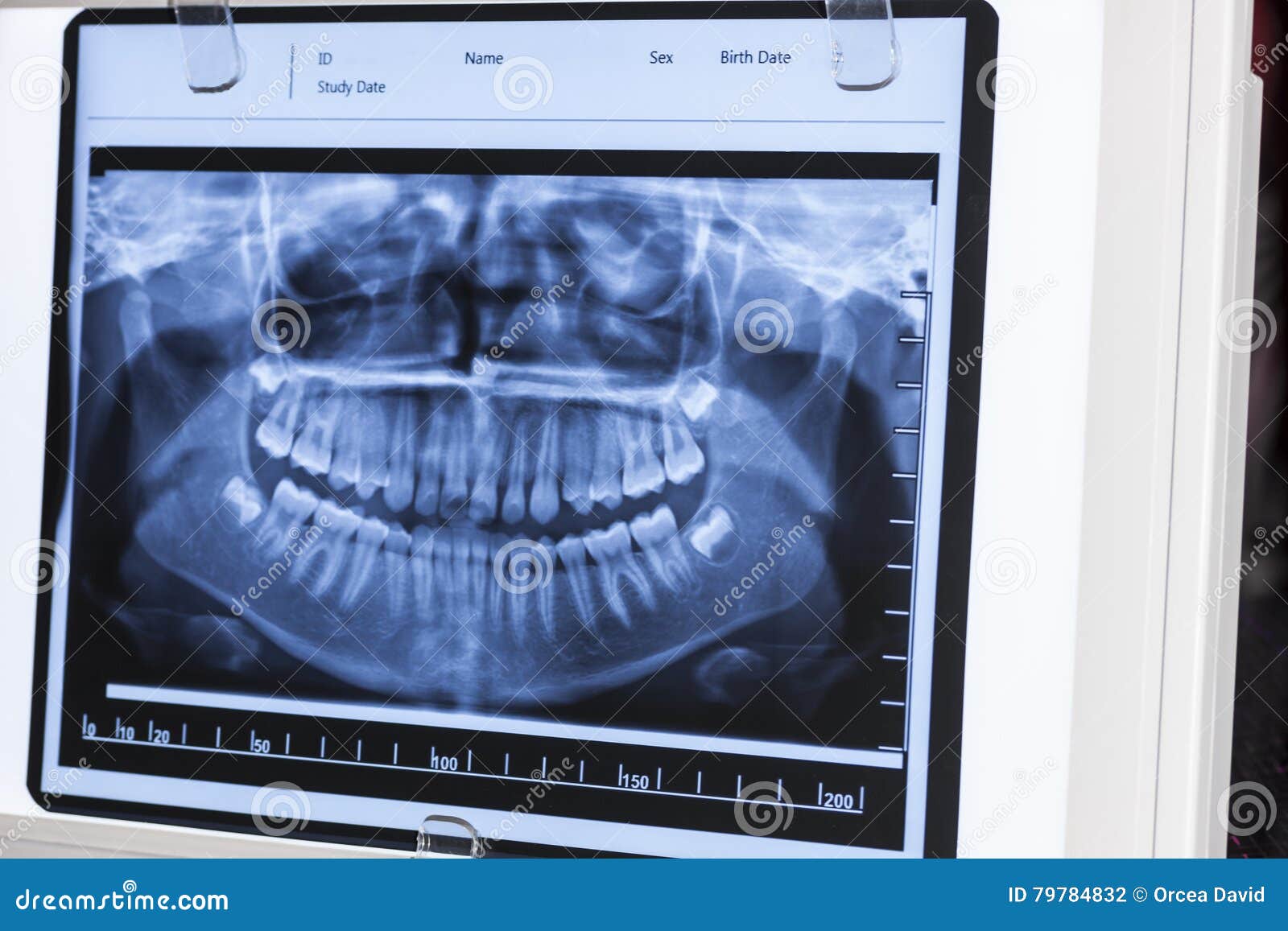 Xray Panoramic Dental stock photo. Image of diagnosis 79784832