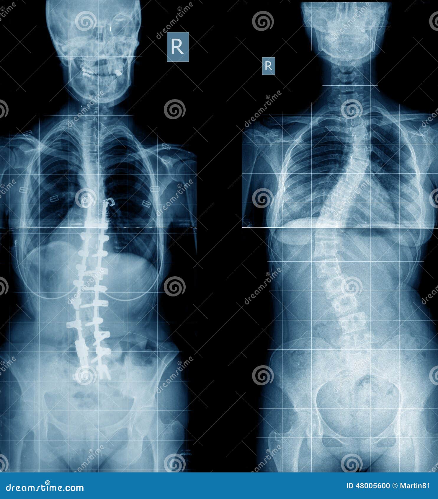 Xray of scoliosis human