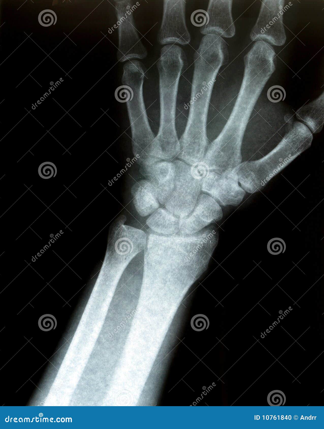 Xray Of A Wrist Stock Photo - Image: 10761840