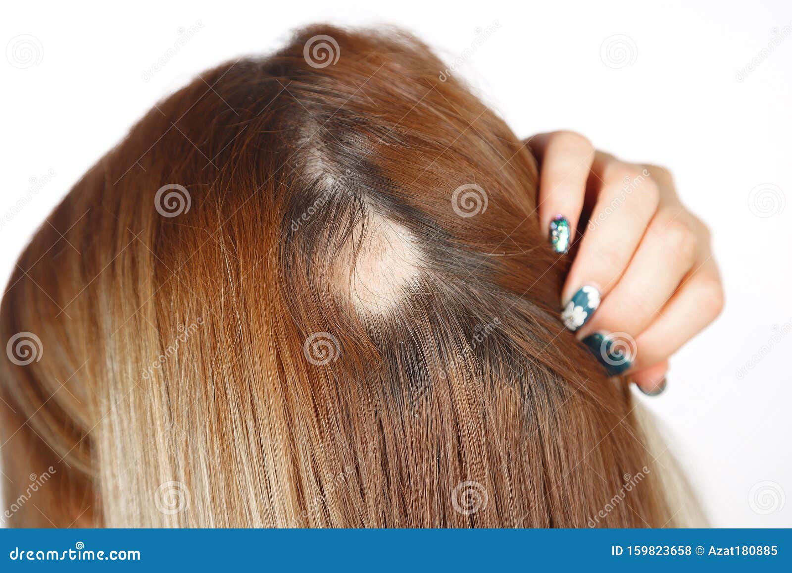30 Year Old Caucasian Woman with Spot Alopecia, Bald Spot on Her Head