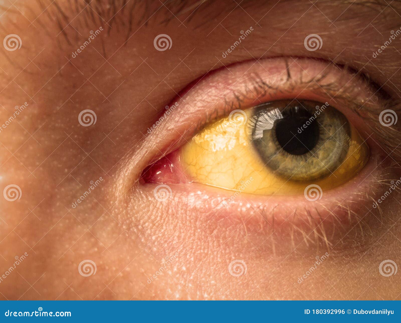 yellow staining of the sclera of the eye in diseases of the liver, cirrhosis, hepatitis
