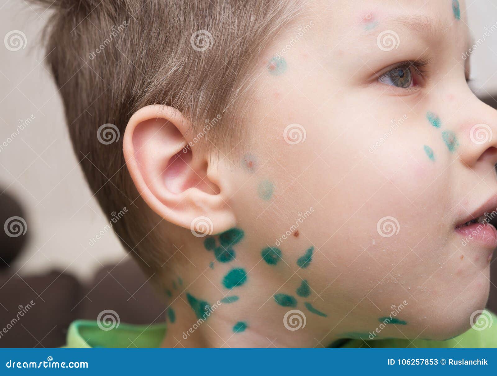 boy with chicken pox