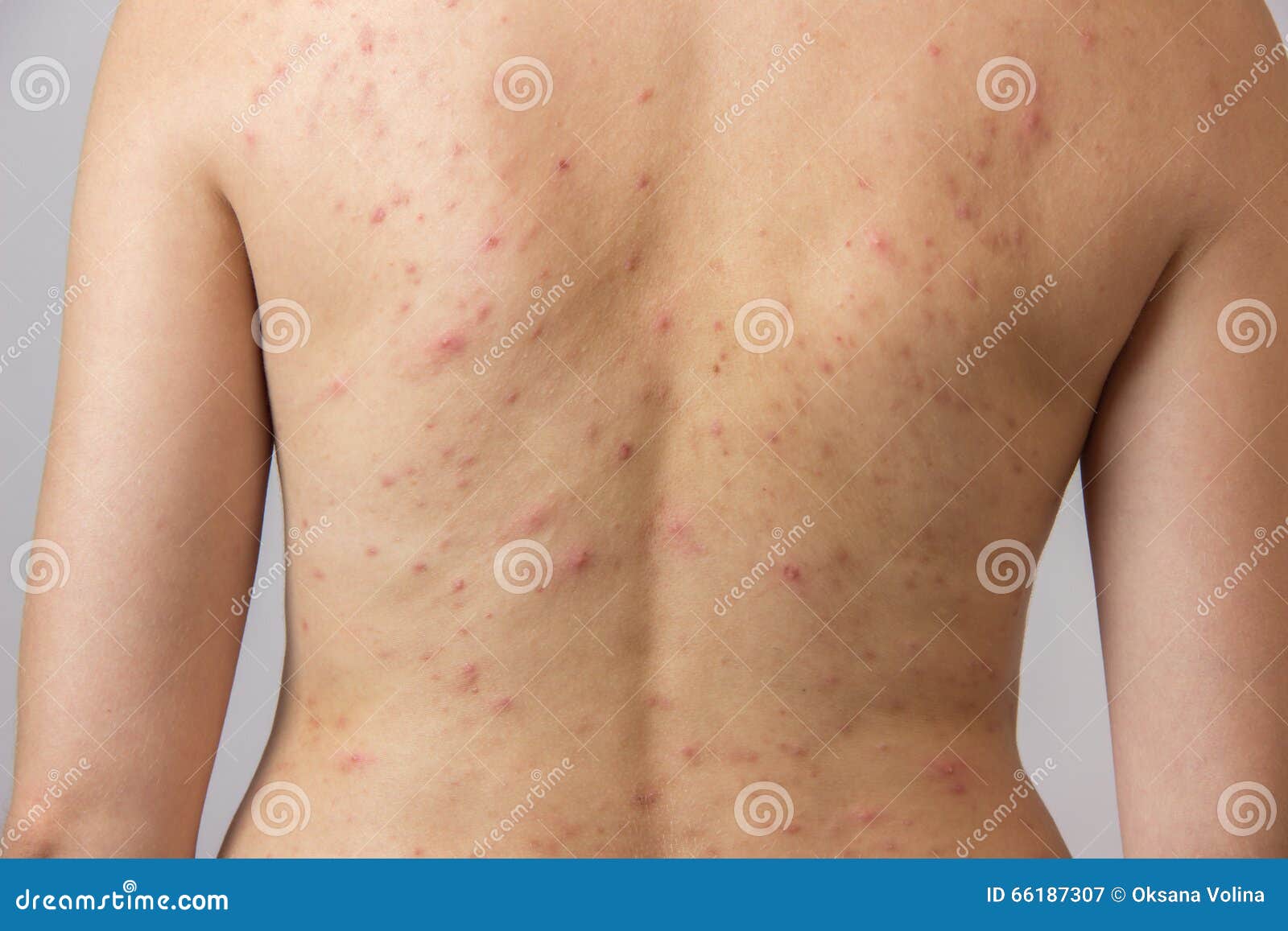 Red Spots On Stomach/back/chest - Skin Forum - eHealthForum