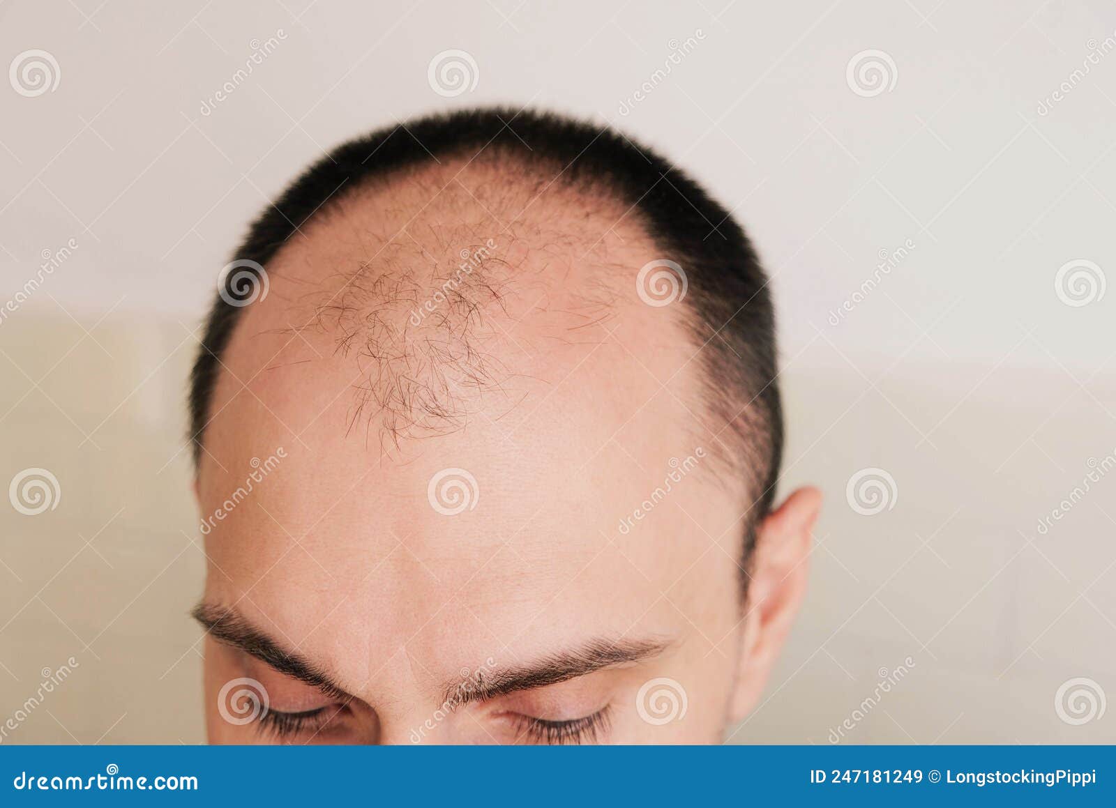 Male Pattern Hair Loss Problem, Close Up Stock Photo - Image of health,  balding: 179374046