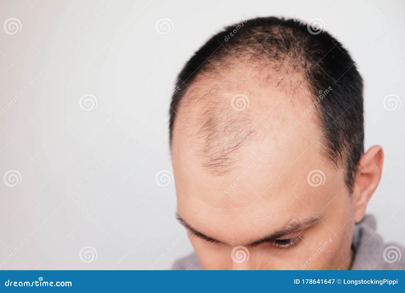 Young Man Losing Hair on Temples, Close Up Stock Image - Image of hormones, person: 178641647 Young Man Losing Hair on Temples, Close Up Stock Image - Image of hormones, person: 178641647