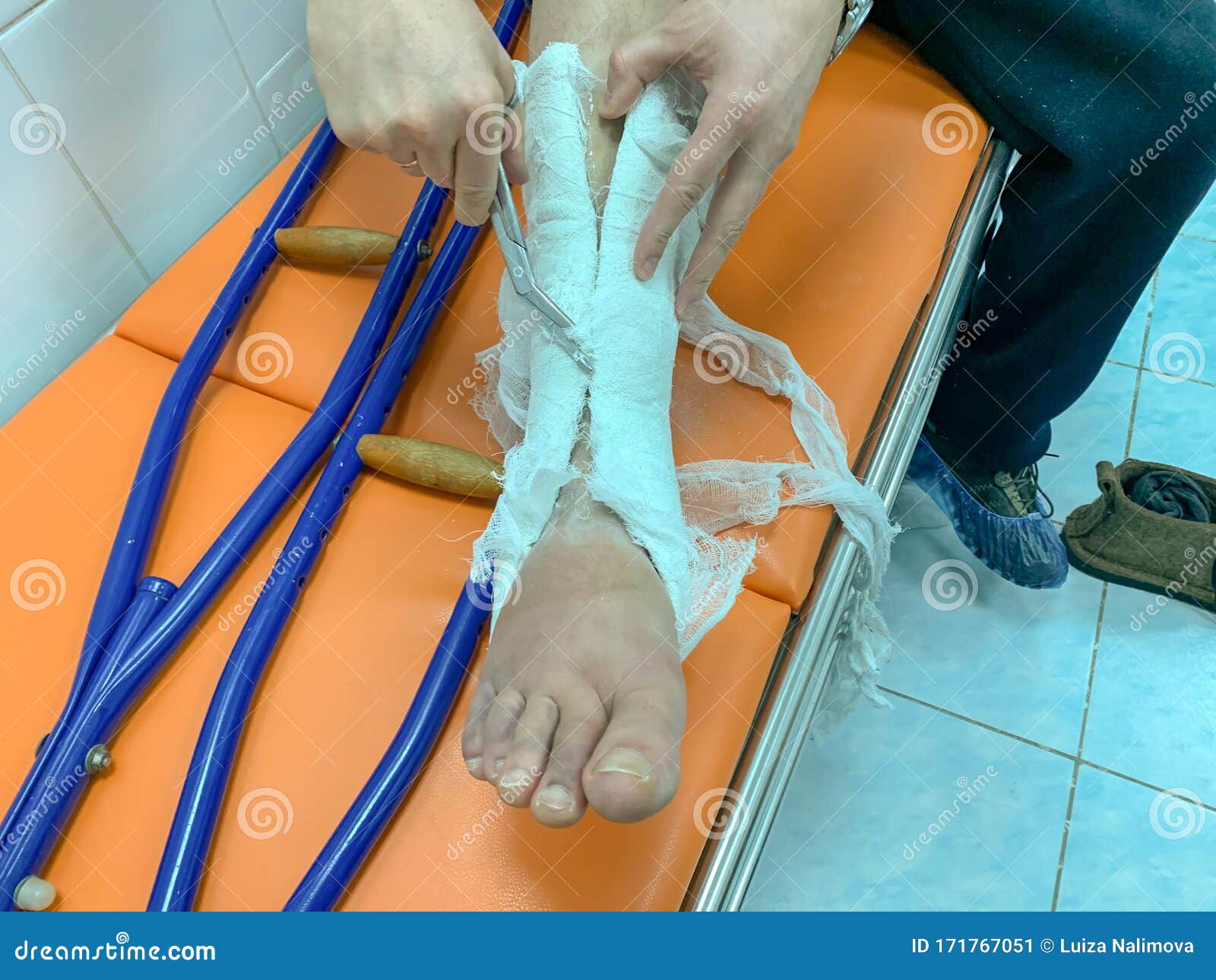 Body Cast Catheter Body Cast Catheter
