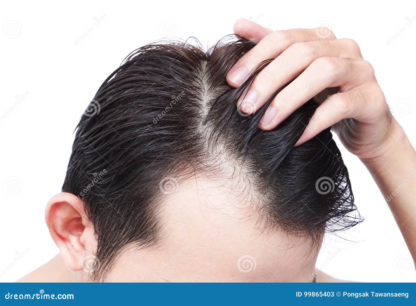 Young Man Serious Hair Loss Problem for Health Care Shampoo and Stock Image  - Image of concept, human: 99865403