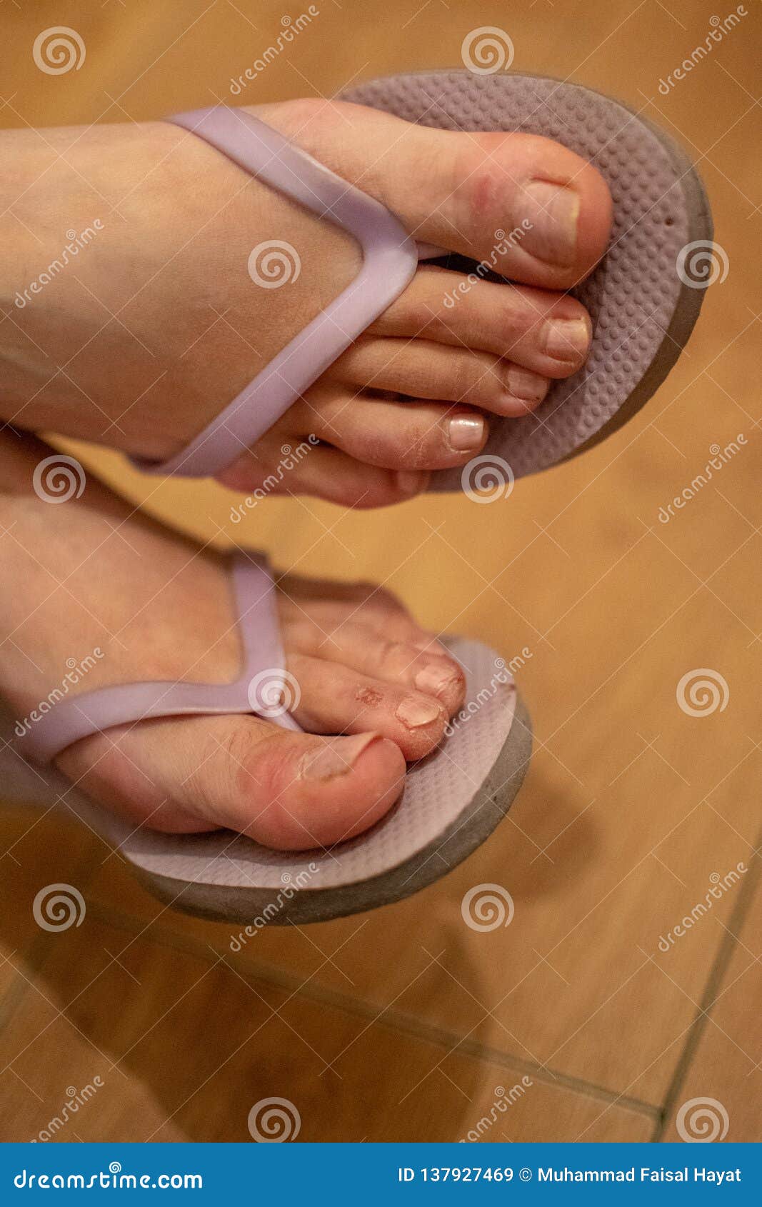 Young Woman Feet Wearing Flip Flop Stock Image - Image of feet, medical ...